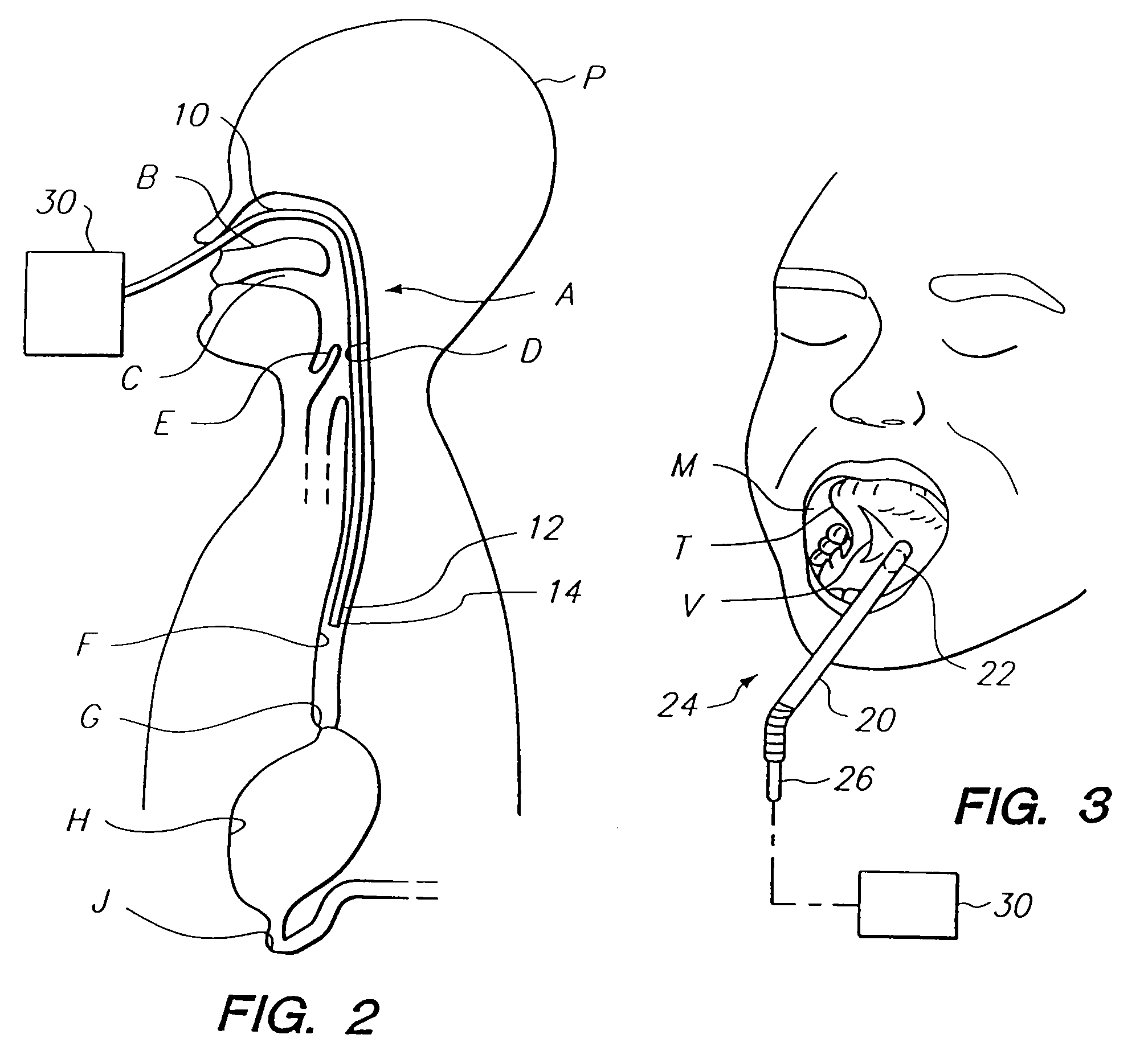 Device for assessing perfusion failure in a patient by measurement of blood flow