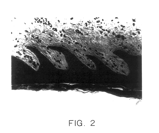 Non-viable keratinocyte cell composition or lysate for promoting wound healing