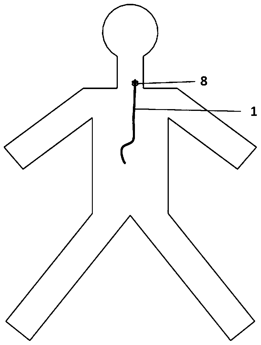 Device for indwelling and removing local internal radiation therapy for venous tumor thrombus