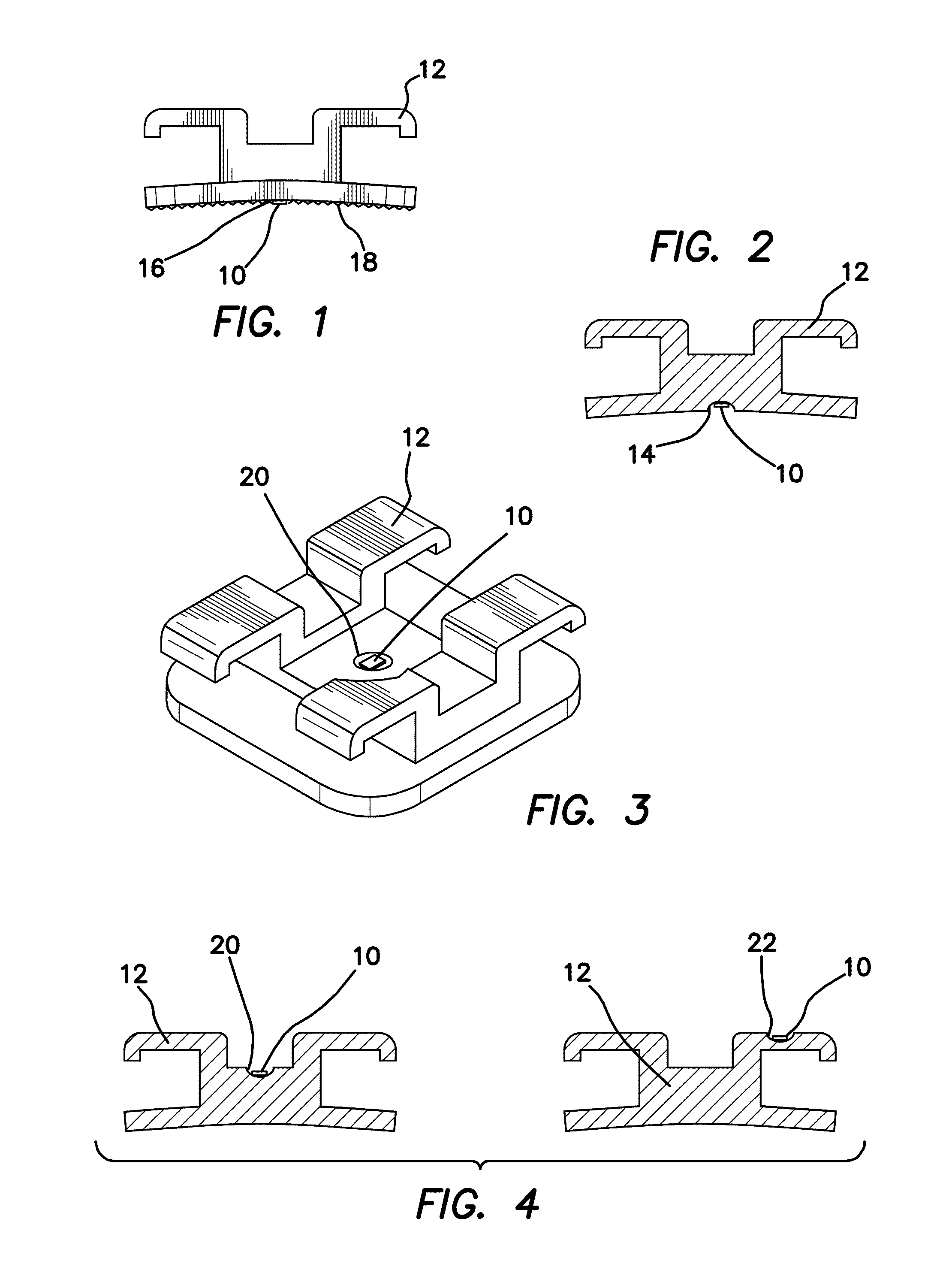 Method for Using Radio Frequency Identification Microchips in Orthodontic Brackets