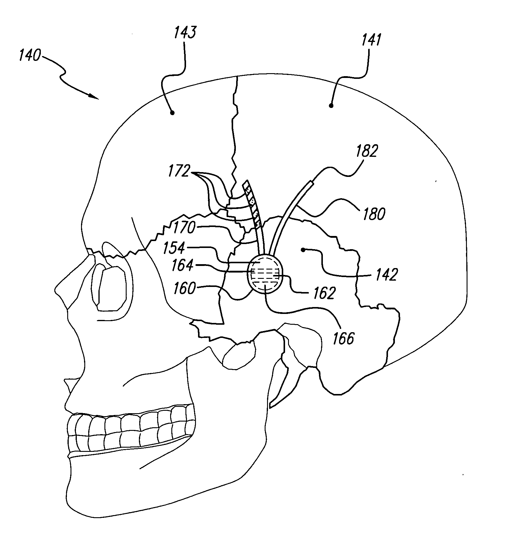 Systems and methods for trestment of obesity and eating disorders by electrical brain stimulation and/ or drug infusion