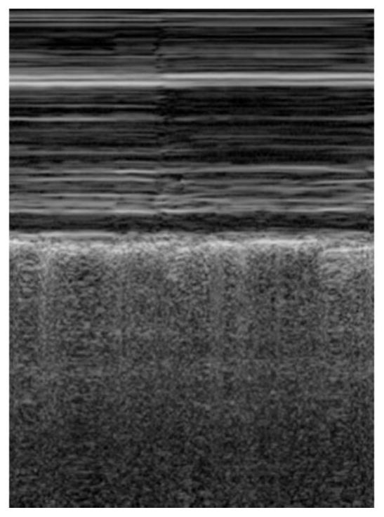 Automatic pneumothorax detection system based on B-mode ultrasound