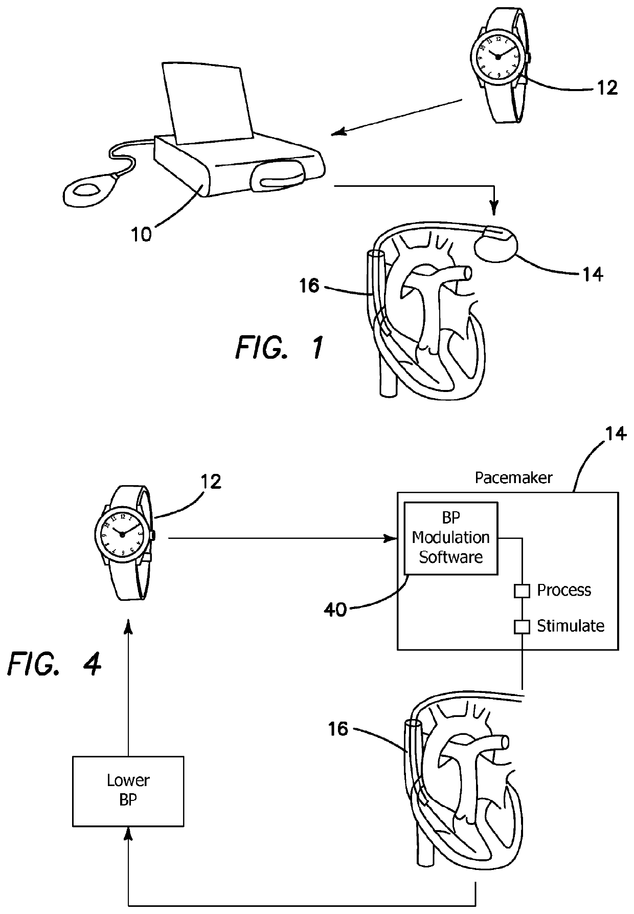 A method and apparatus for treatment of drug resistant hypertension associated with impaired left ventricular function and bradycardia using a cardiac pacemaker