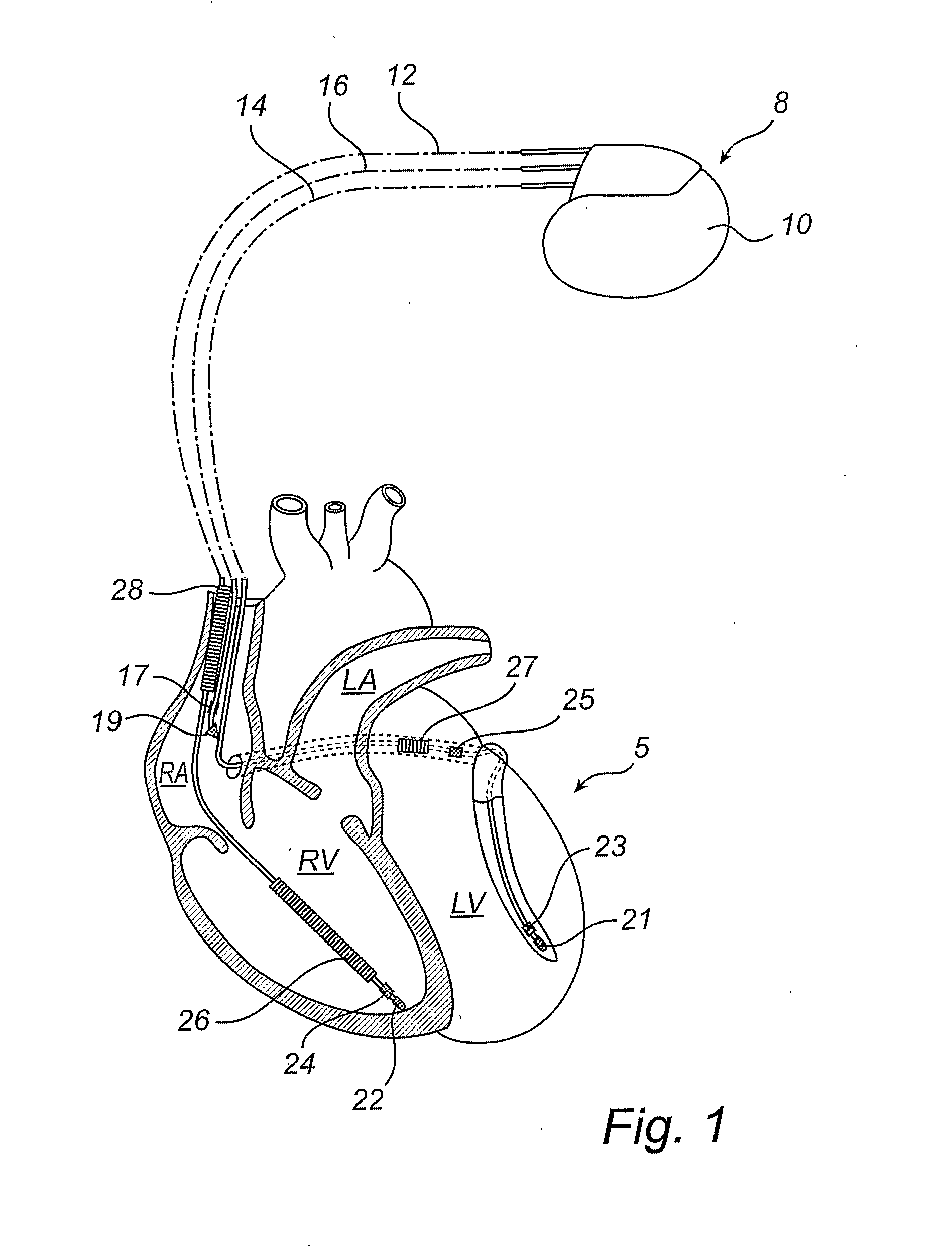 Implantable medical device and method for multisite measurement of intracardiac impedance