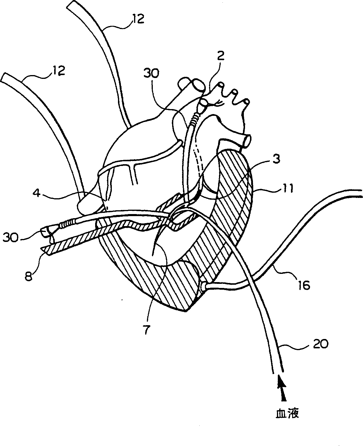 Auxiliary device for pulsatile coronary artery bypass