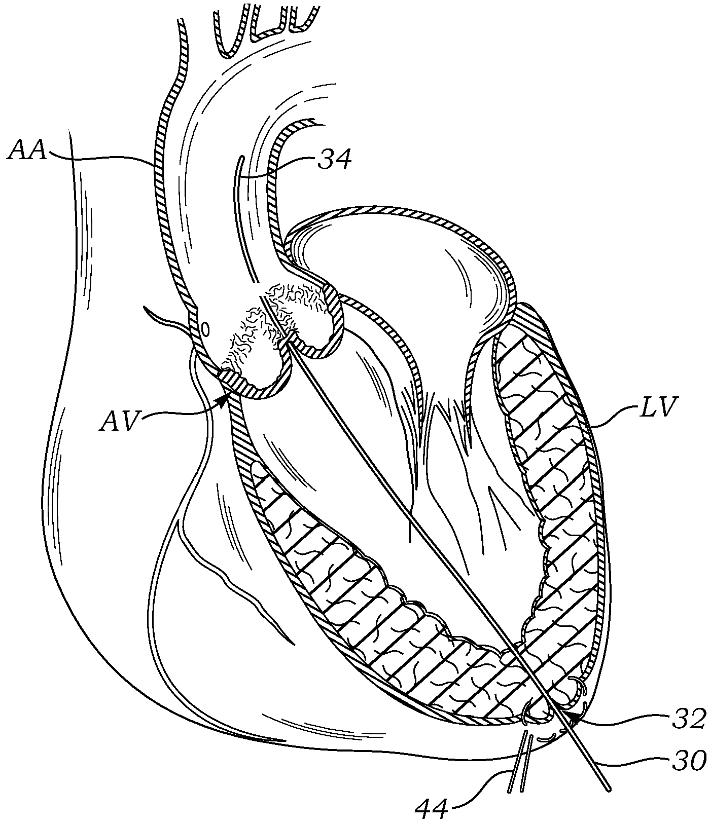 Transapical deliverry system for heart valves