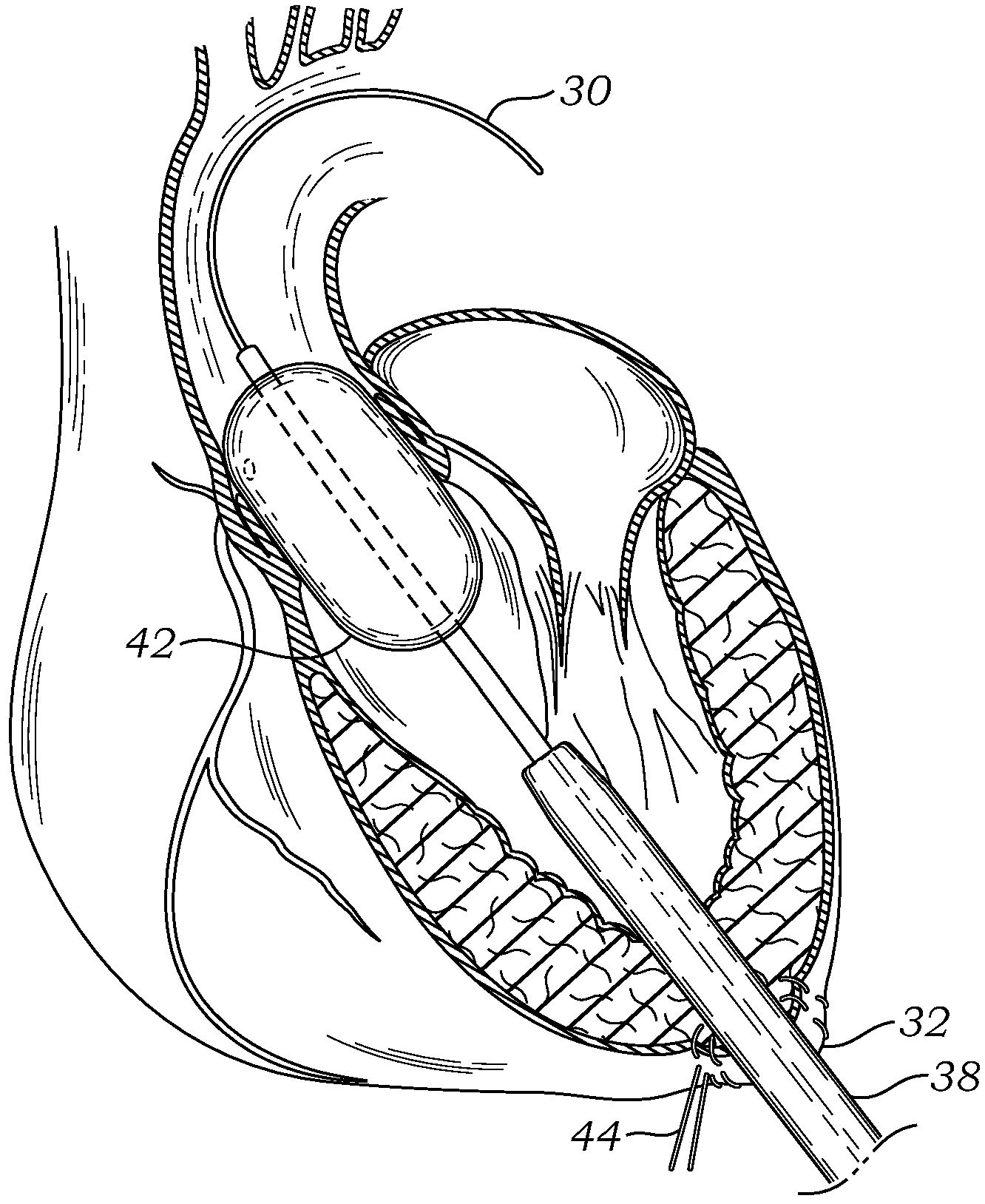 Transapical deliverry system for heart valves