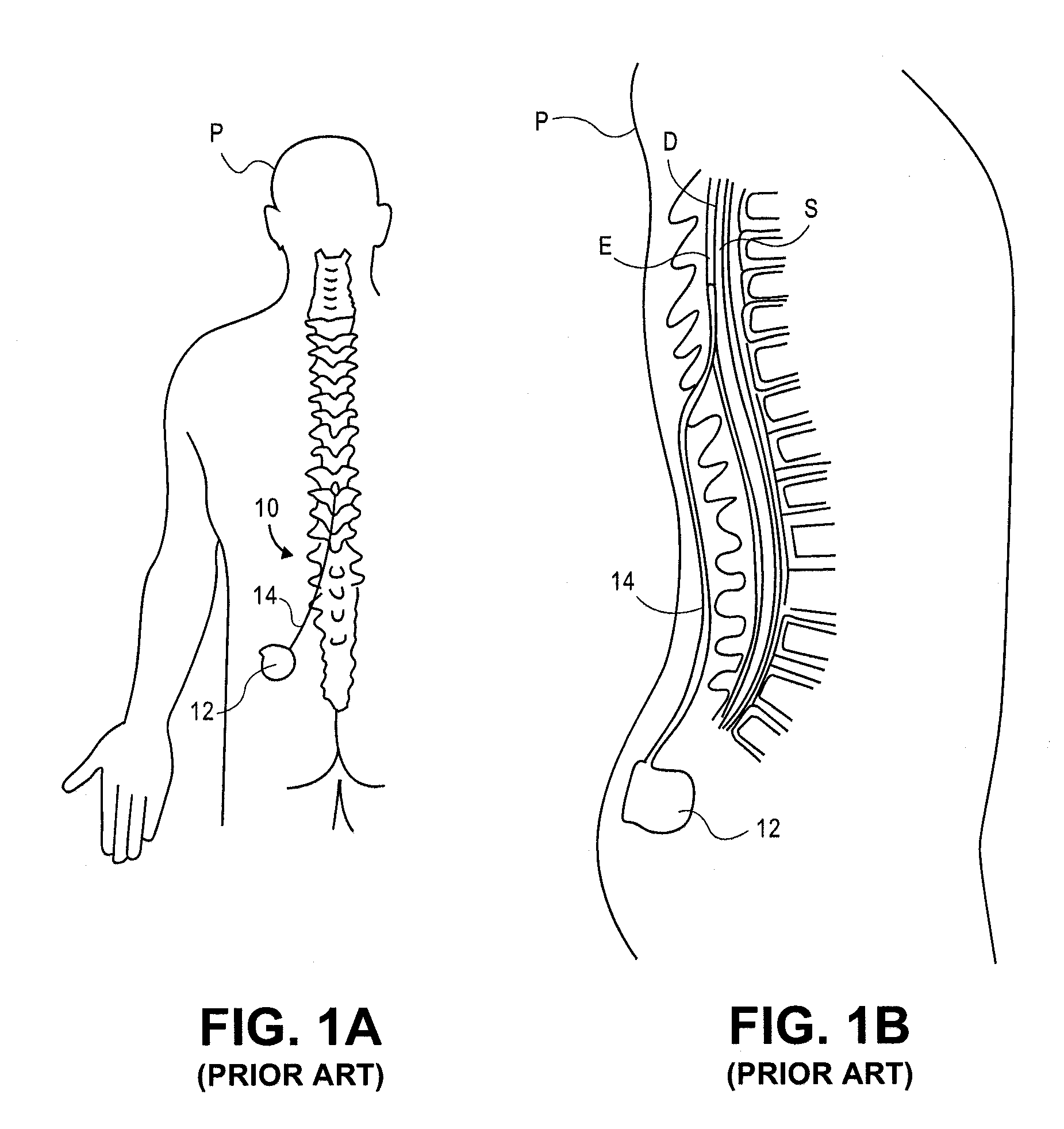 Implantable flexible circuit leads and methods of use