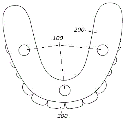 Implant prosthesis for restoration of partial or whole tooth loss and manufacturing method of implant prosthesis