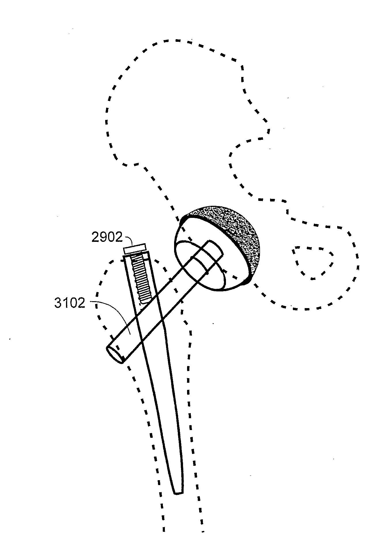 Method and apparatus for total hip replacement