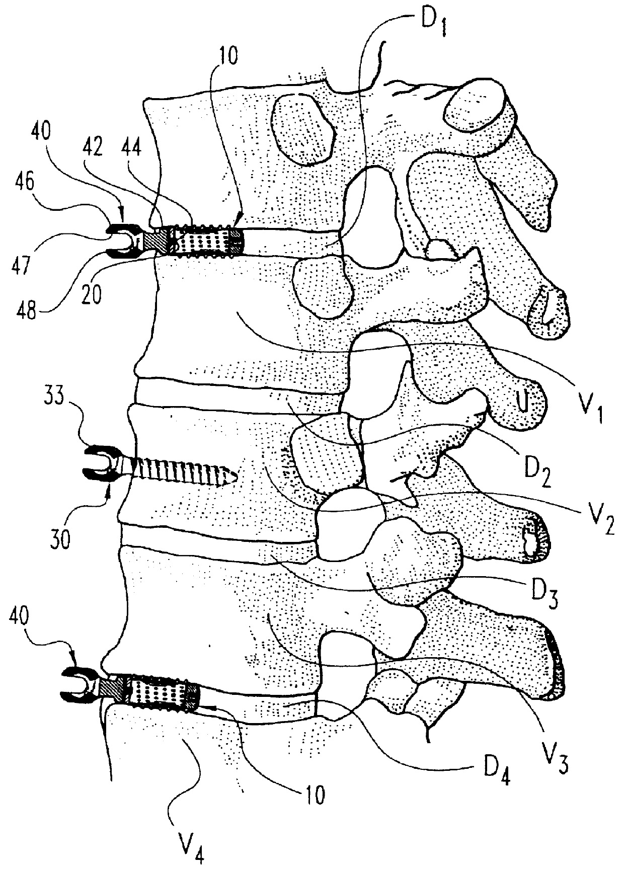 Anterior spinal instrumentation and method for implantation and revision