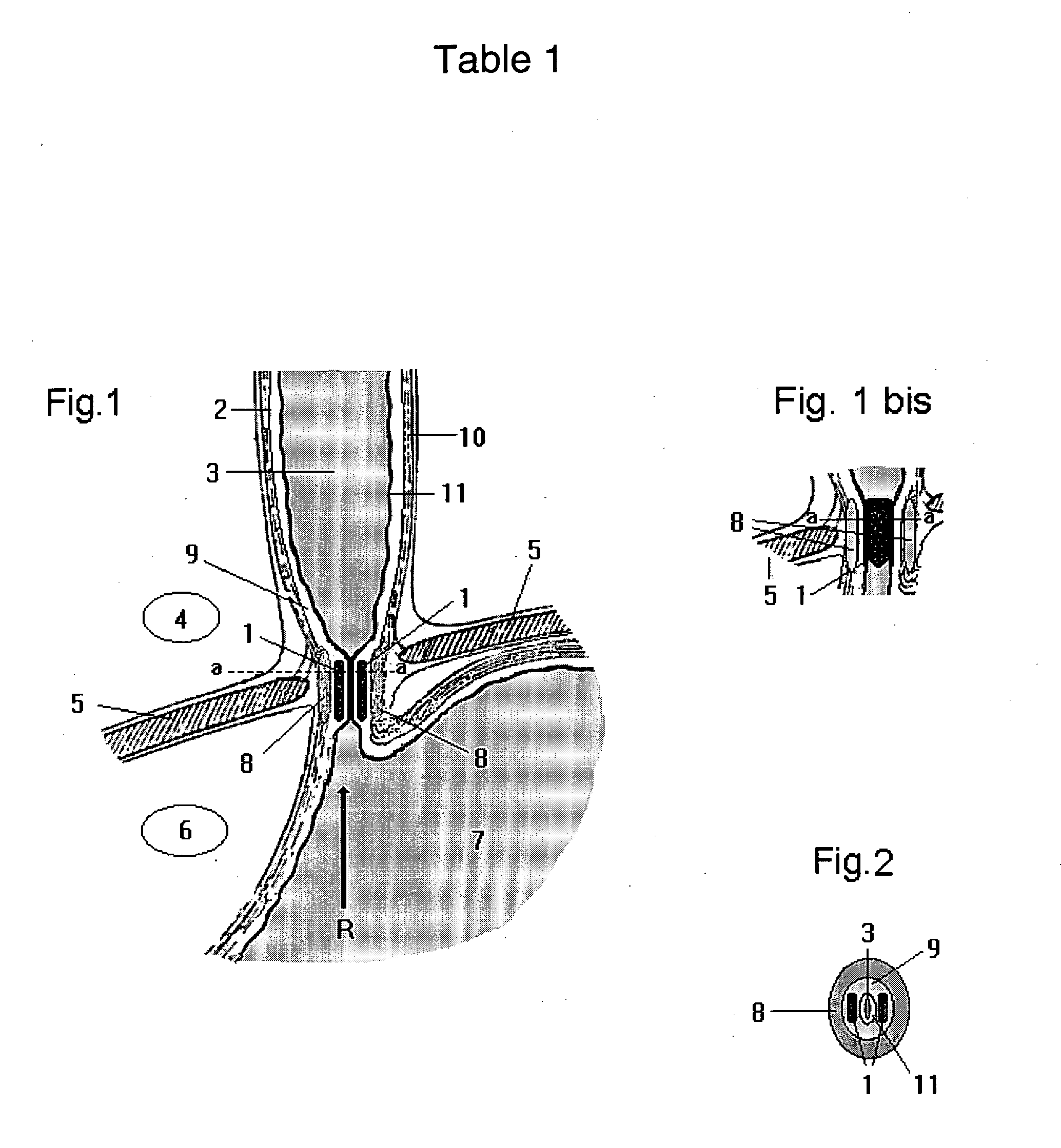 Magnetic device and method to prevent gastroesophageal reflux, fecal incontinence and urinary incontinence