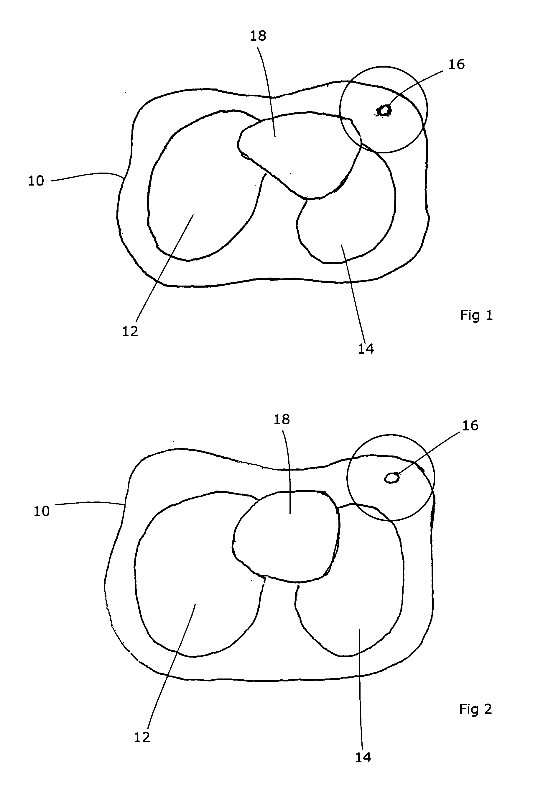 Apparatus for Respiration State Gated Brachytherapy