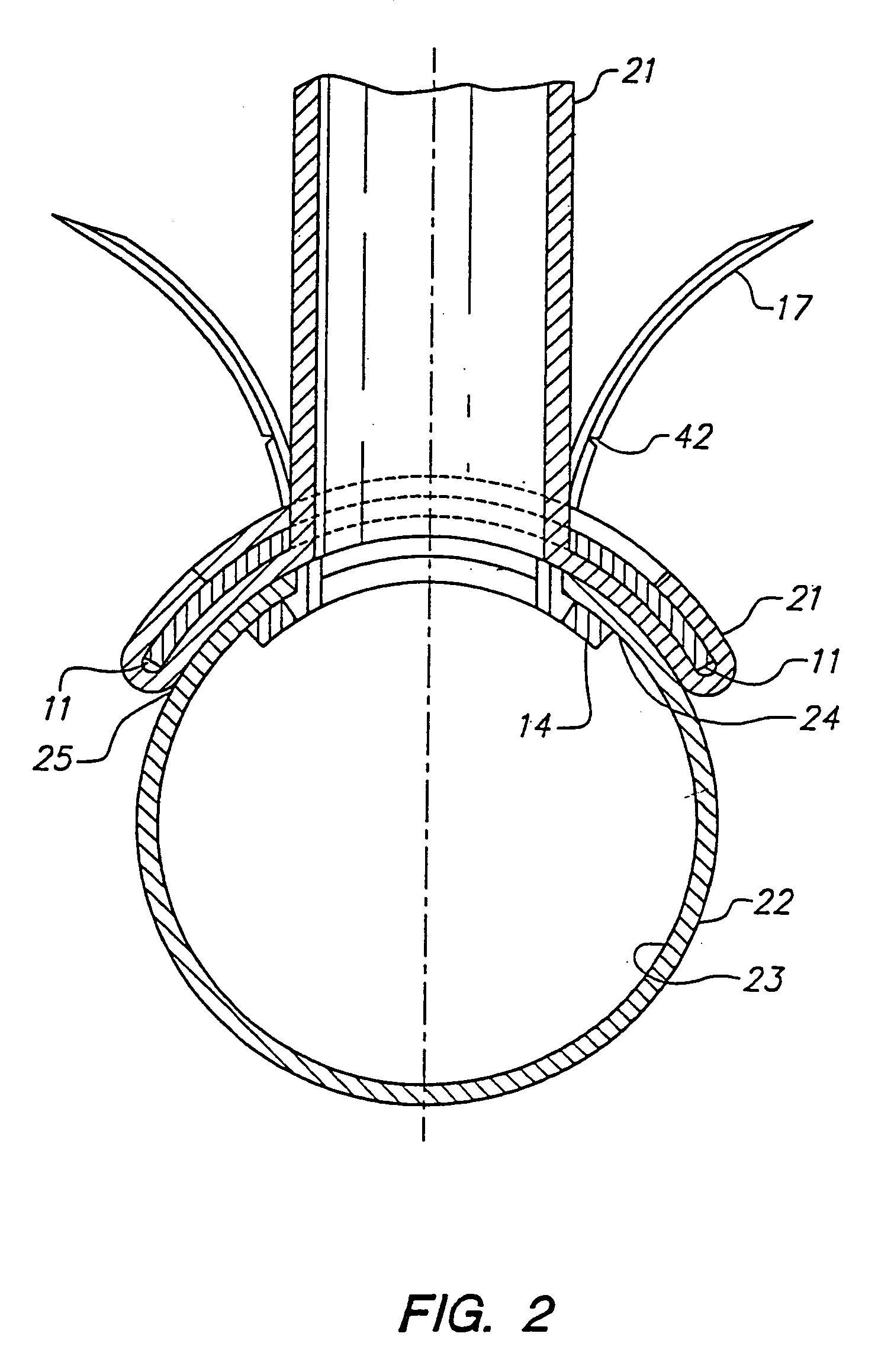 Anastomosis device having at least one frangible member