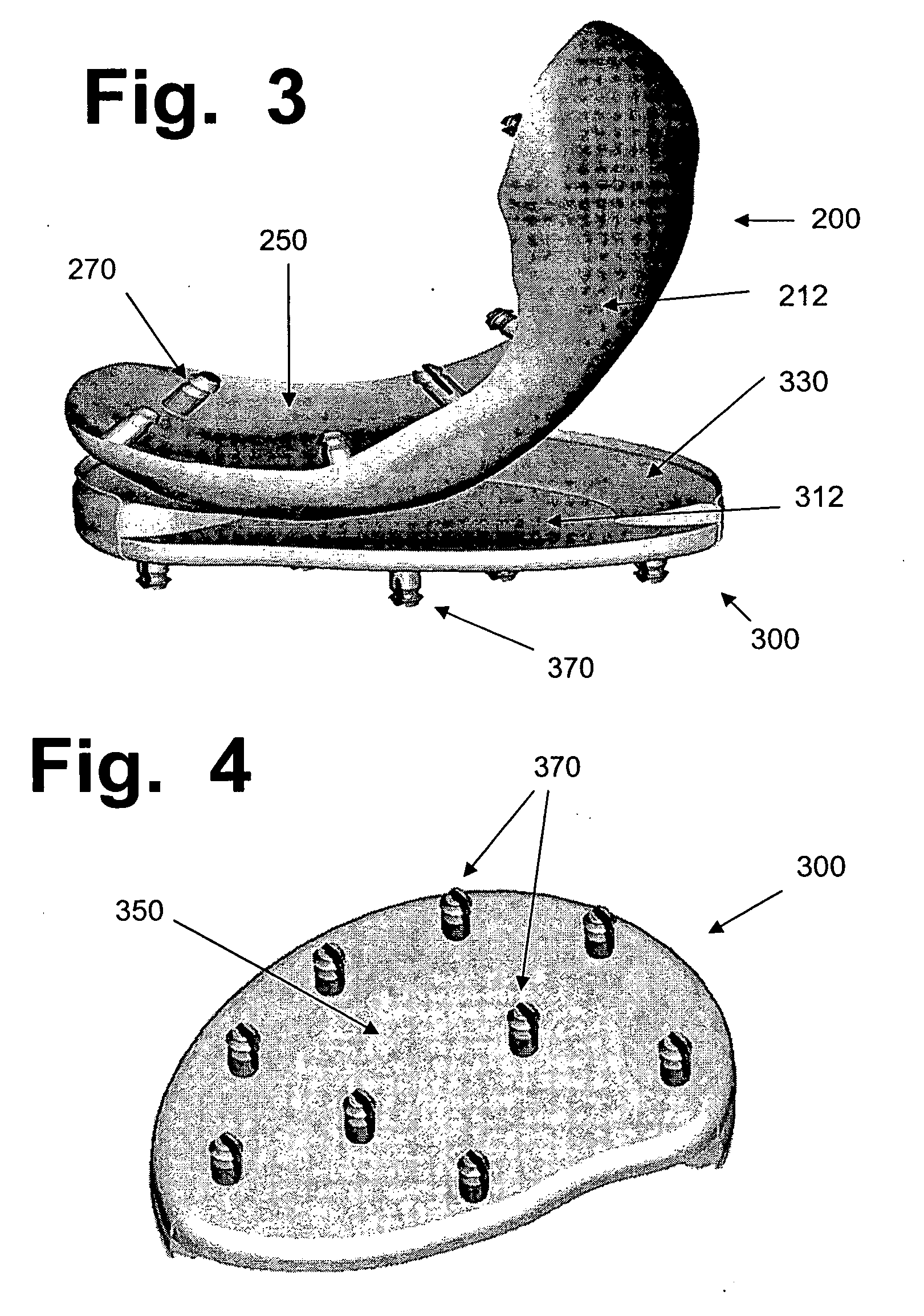 Hydrogel implants for replacing hyaline cartilage, with charged surfaces and improved anchoring