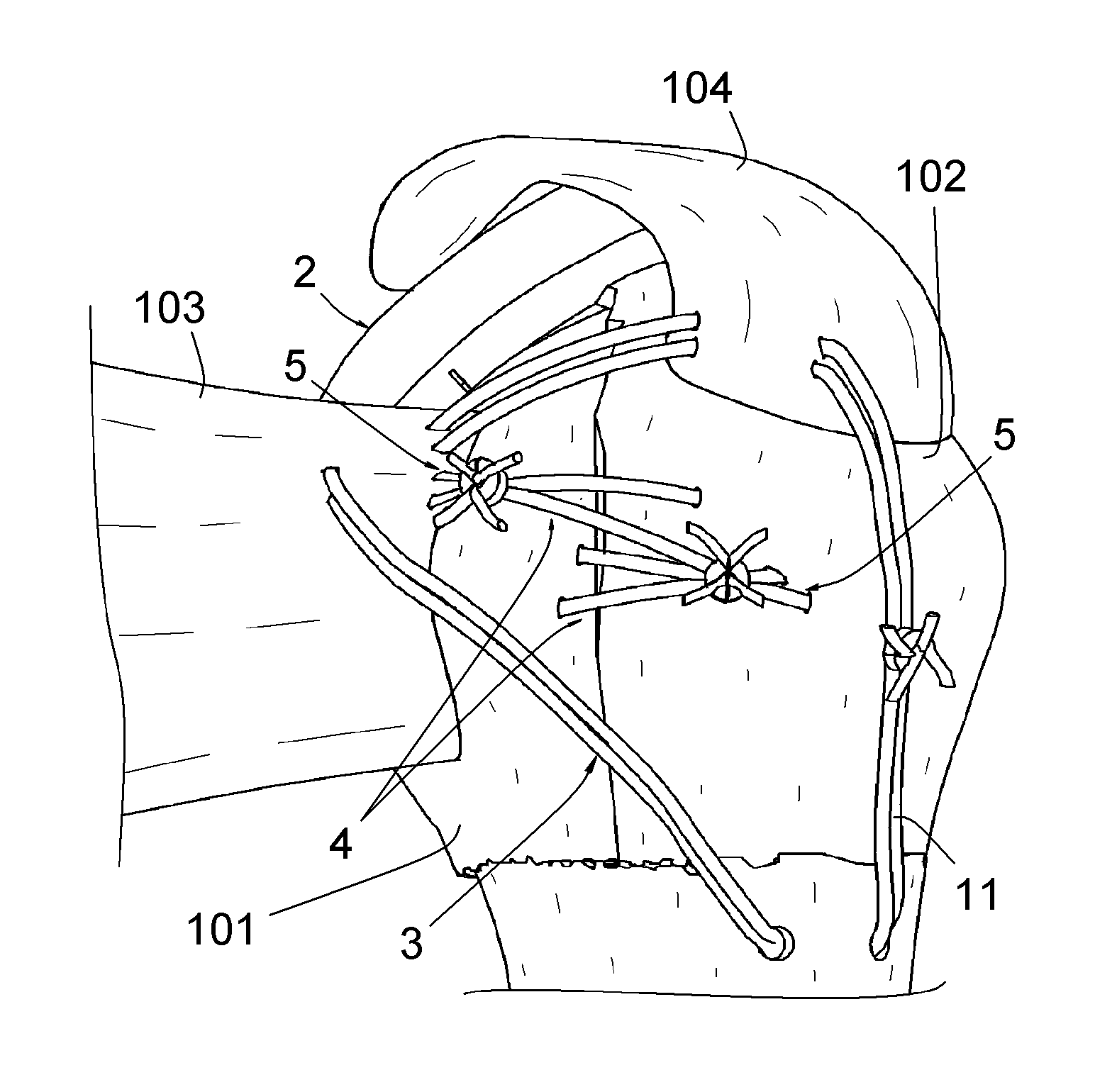 Surgical method for repairing a fractured shoulder joint
