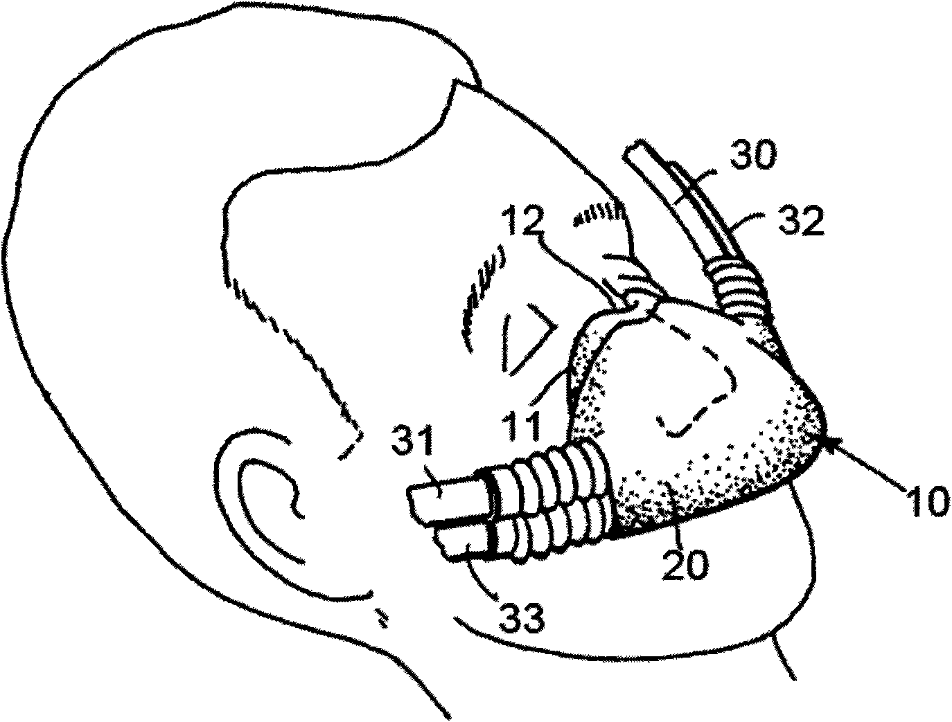Double-layer nasal mask