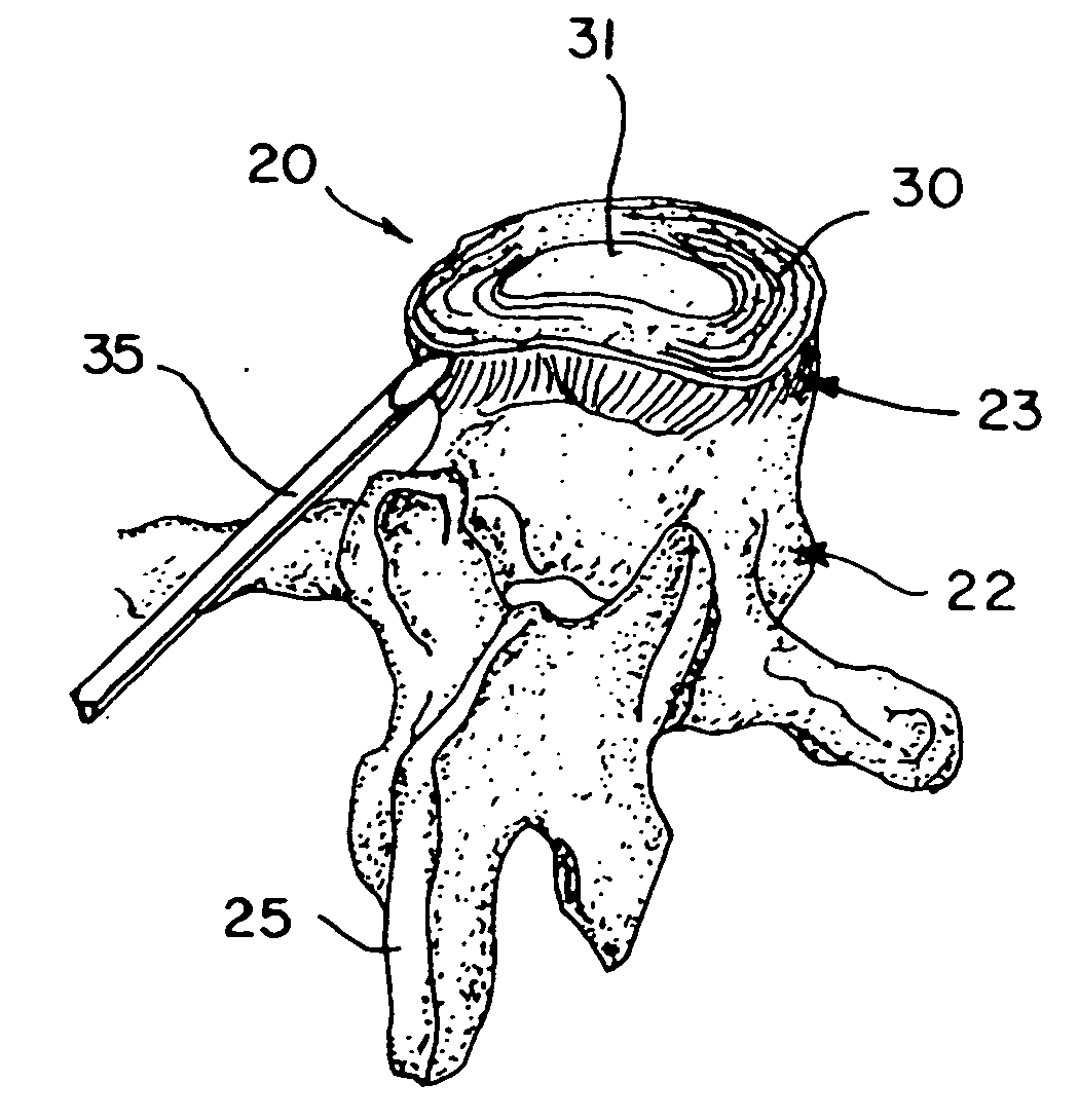 Method and compostion for repair and reconstruction of intervertebral discs and other reconstructive surgery