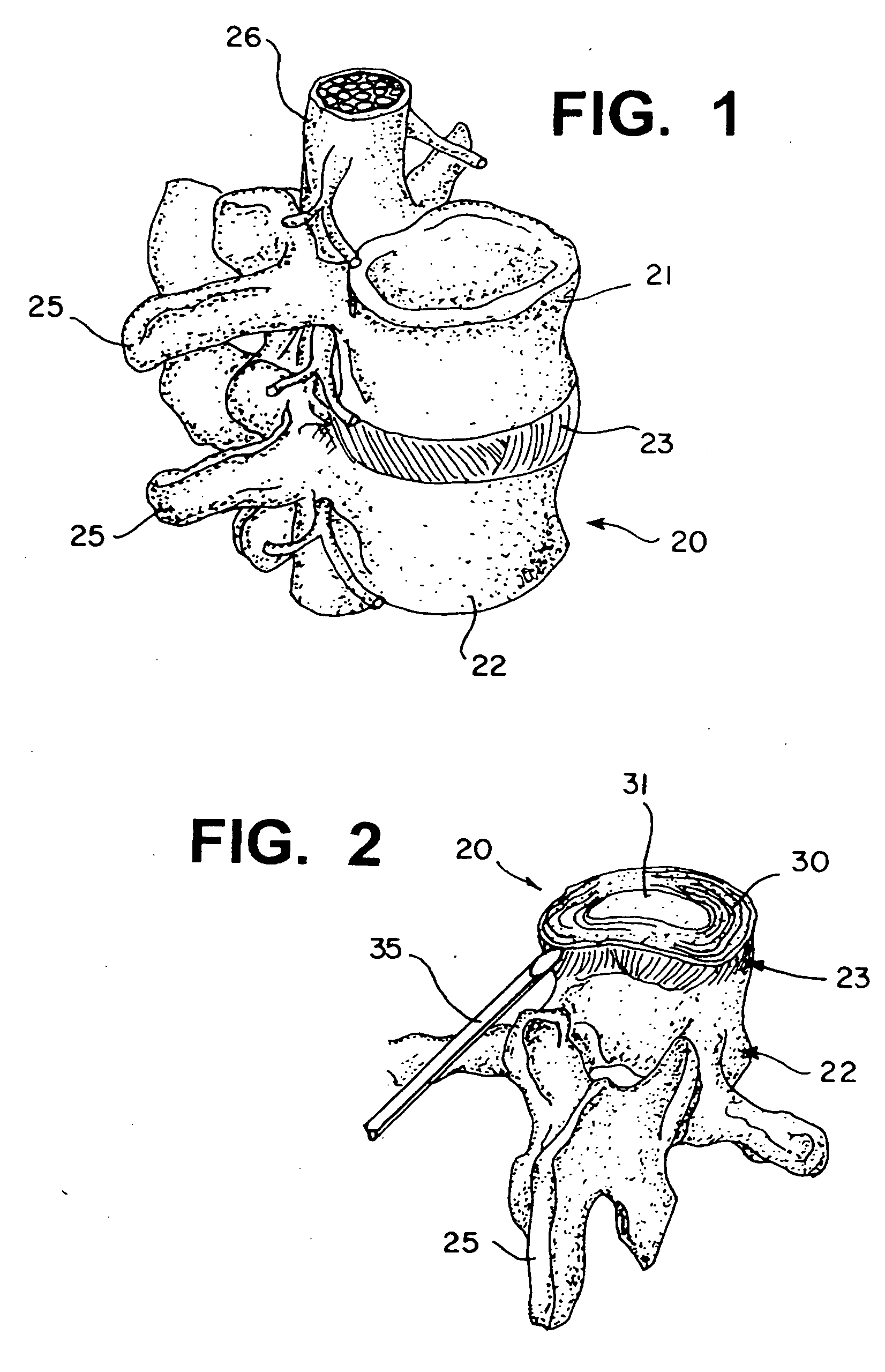 Method and compostion for repair and reconstruction of intervertebral discs and other reconstructive surgery