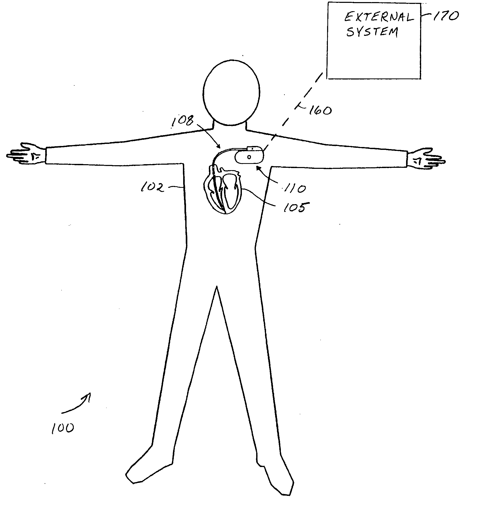 Systems and methods for valvular regurgitation detection