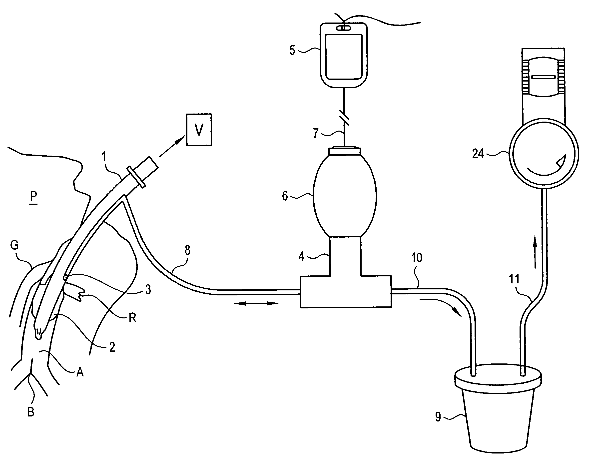 Apparatus for vacuum-assisted irrigation and drainage of a body cavity