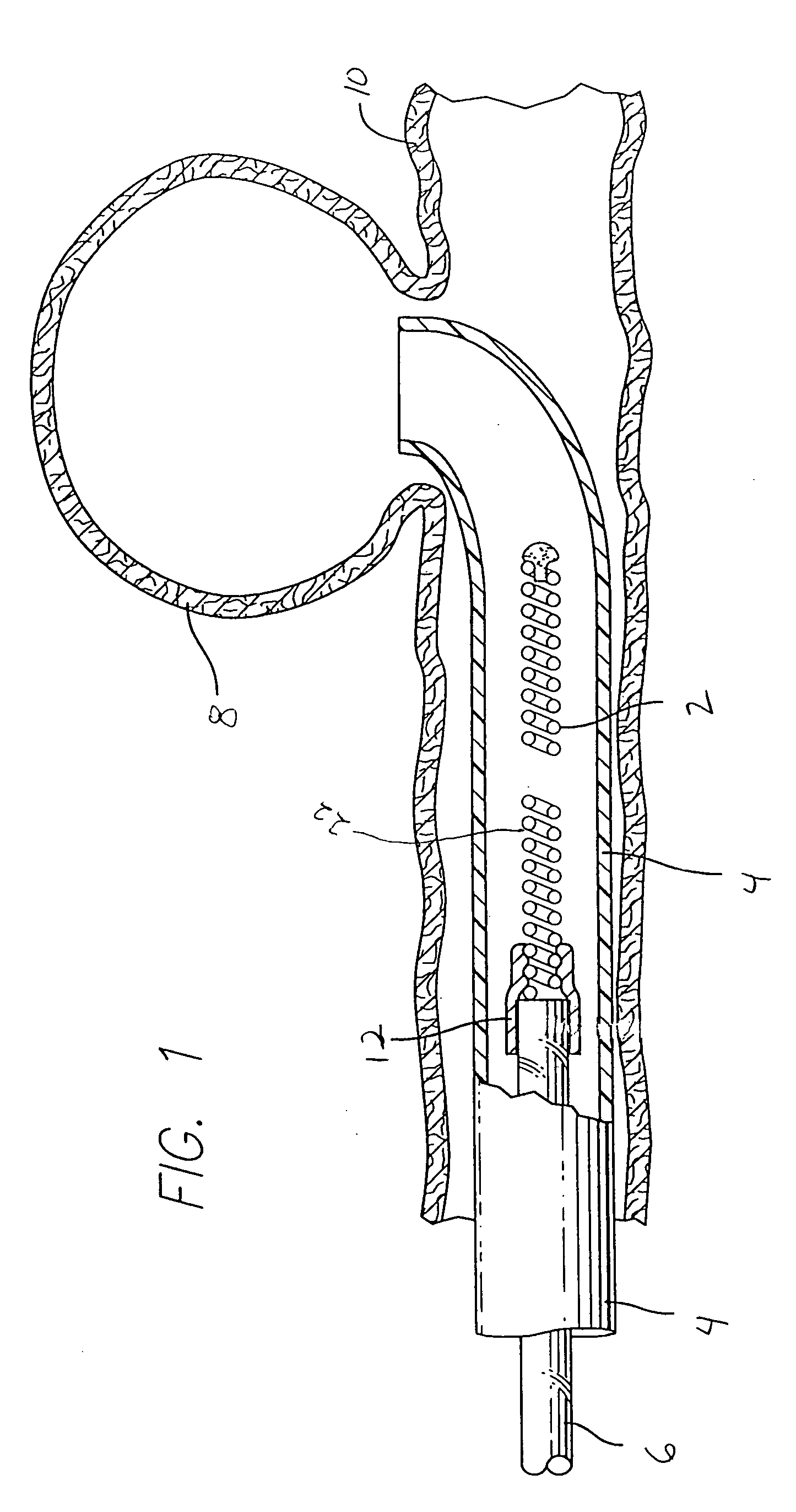 Anchored stent and occlusive device for treatment of aneurysms