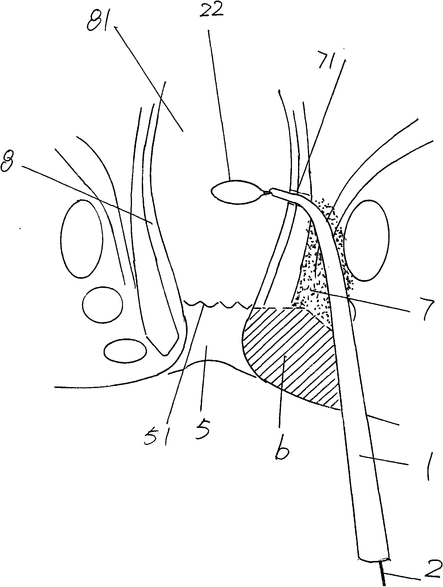Anal fistula seton device