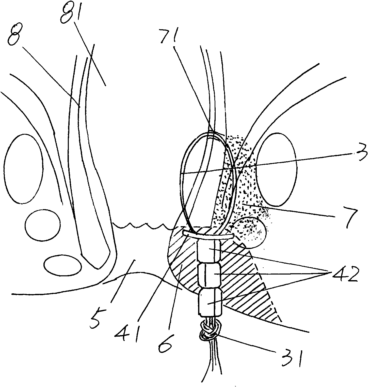 Anal fistula seton device