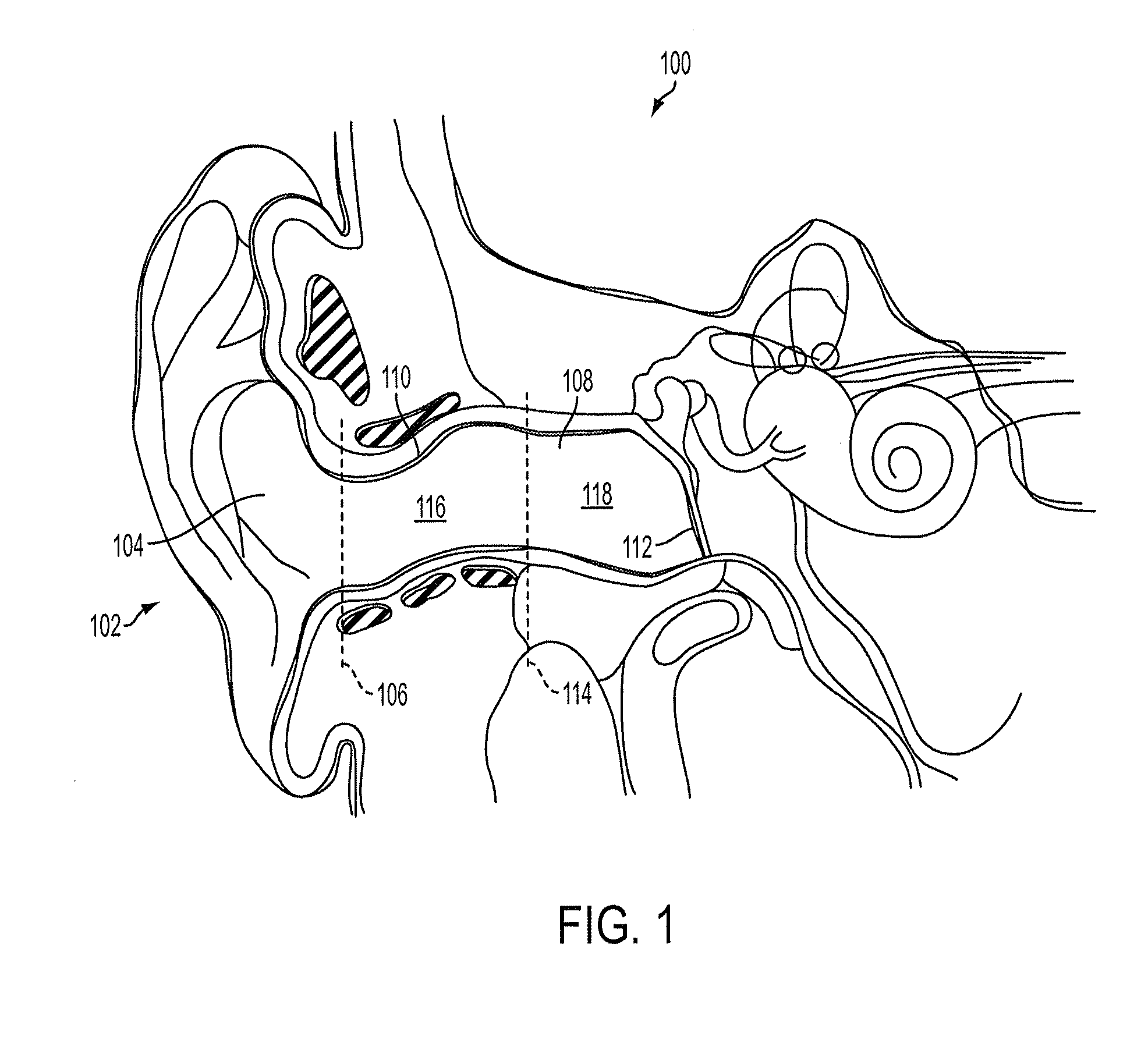 Methods and devices for occluding an ear canal having a predetermined filter characteristic