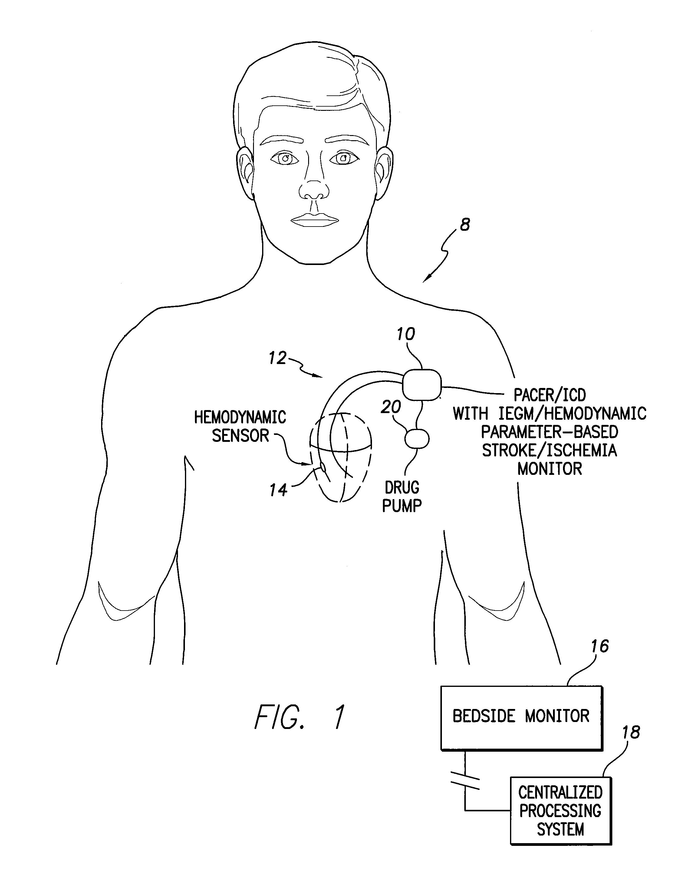Systems and Methods for Use By an Implantable Medical Device for Detecting and Discriminating Stroke and Cardiac Ischemia Using Electrocardiac Signals and Hemodynamic Parameters
