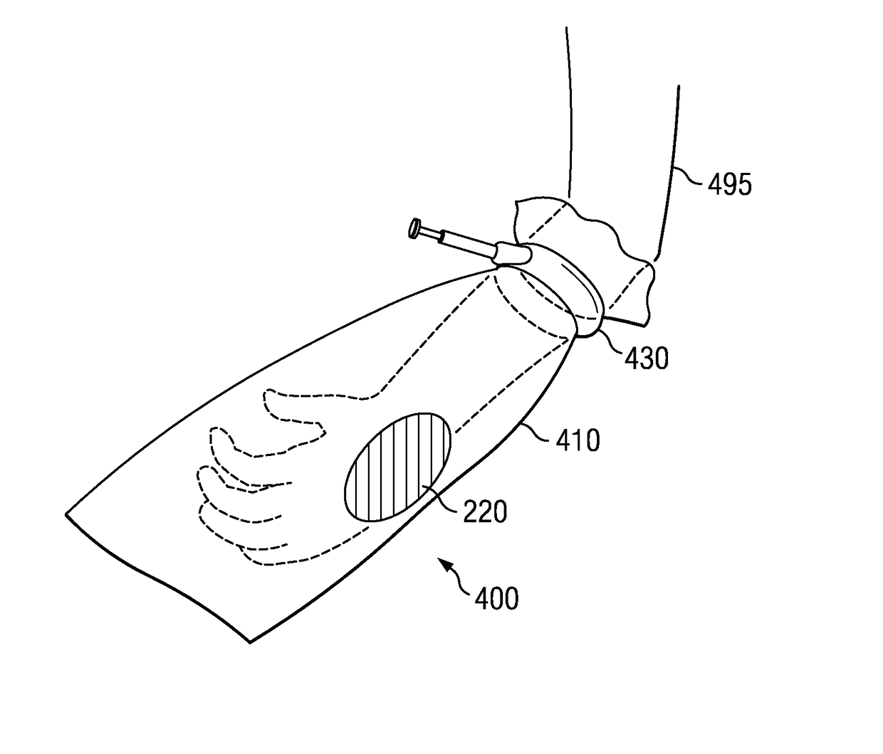 Apparatus and method for deploying a surgical preparation