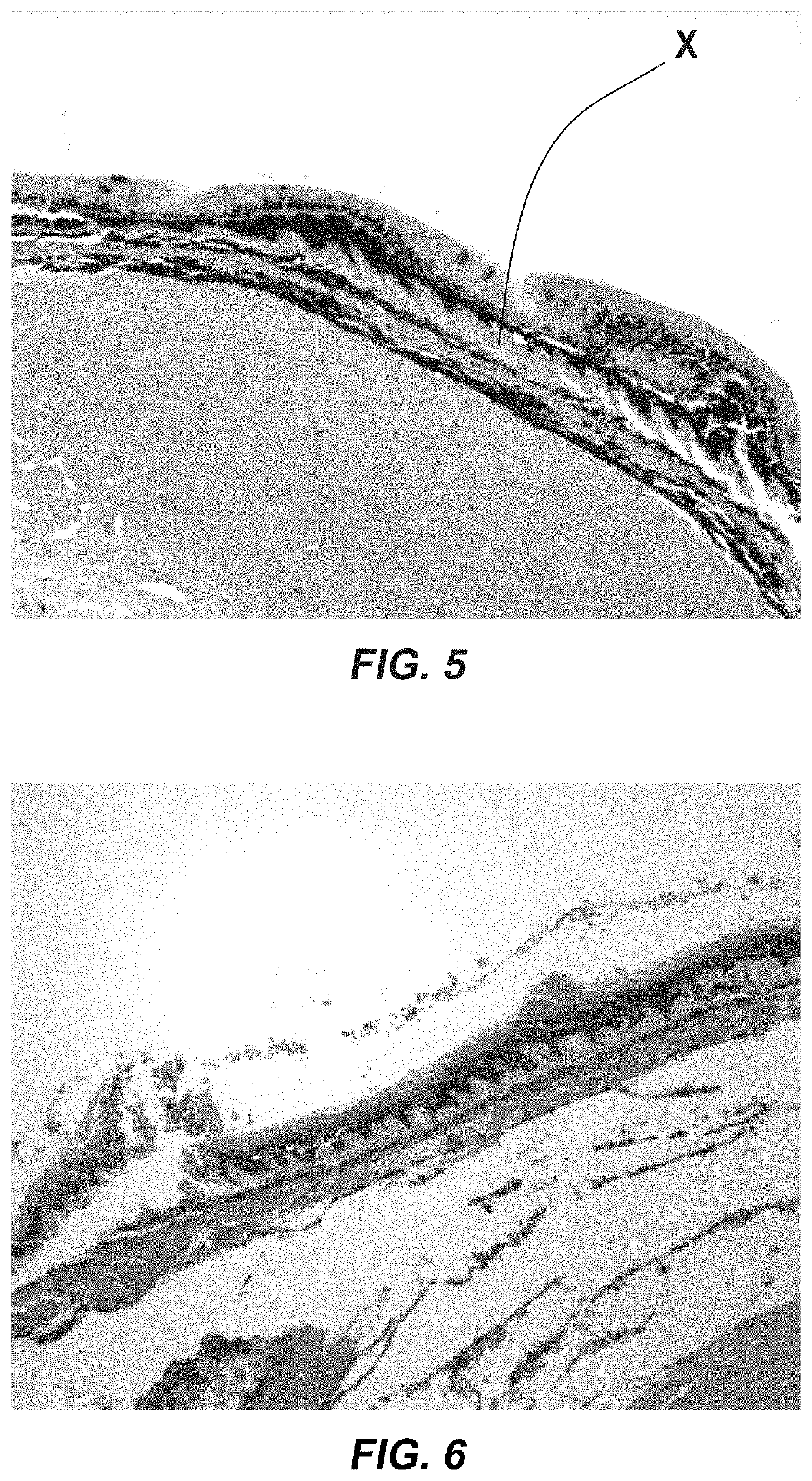 Method and device for treating retinal detachment