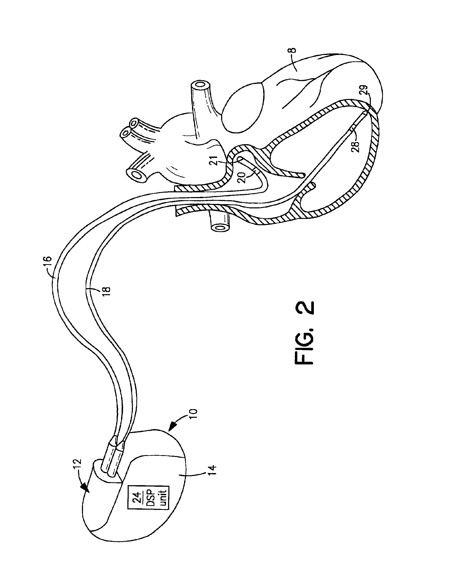 Method and system for transferring and storing data in a medical device with limited storage and memory
