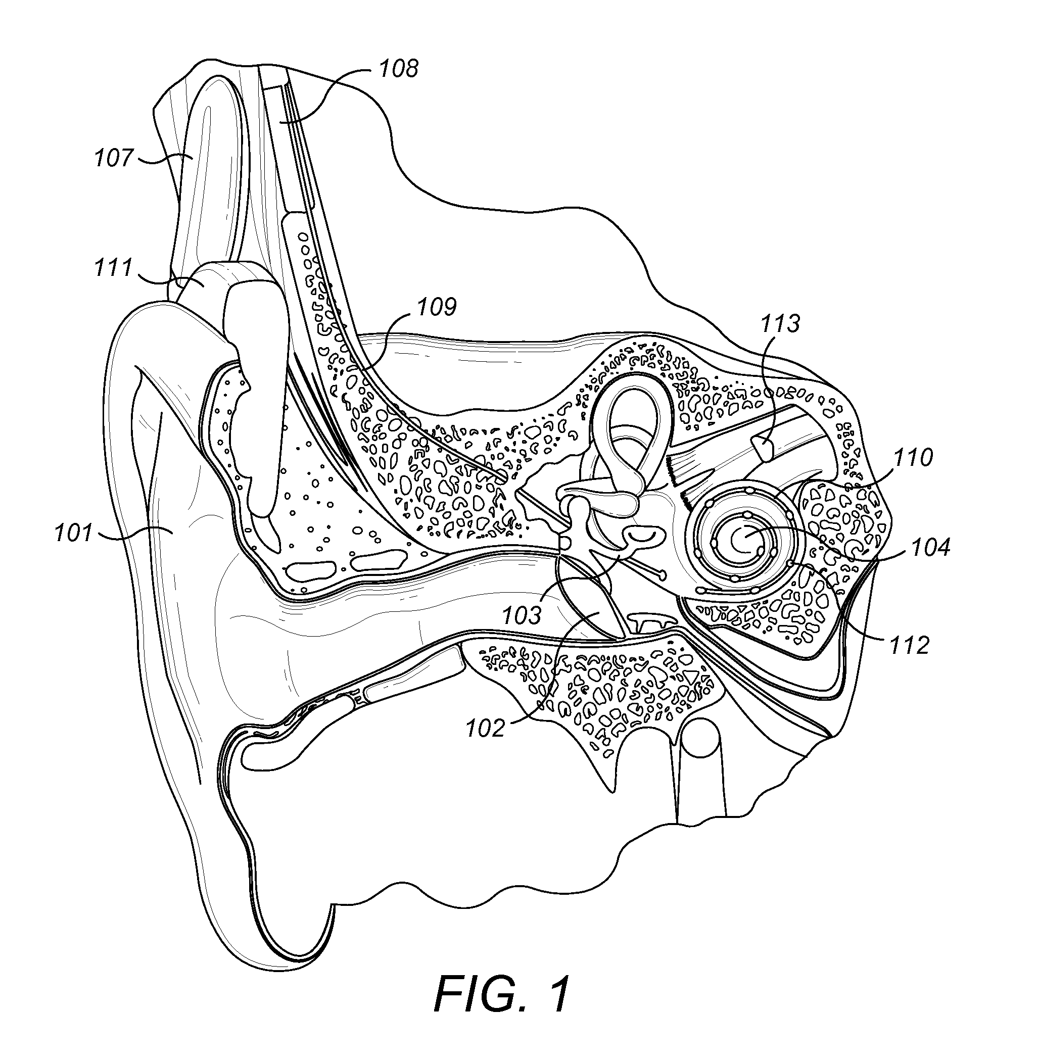 Impact Protection for Implantable Electric Lead