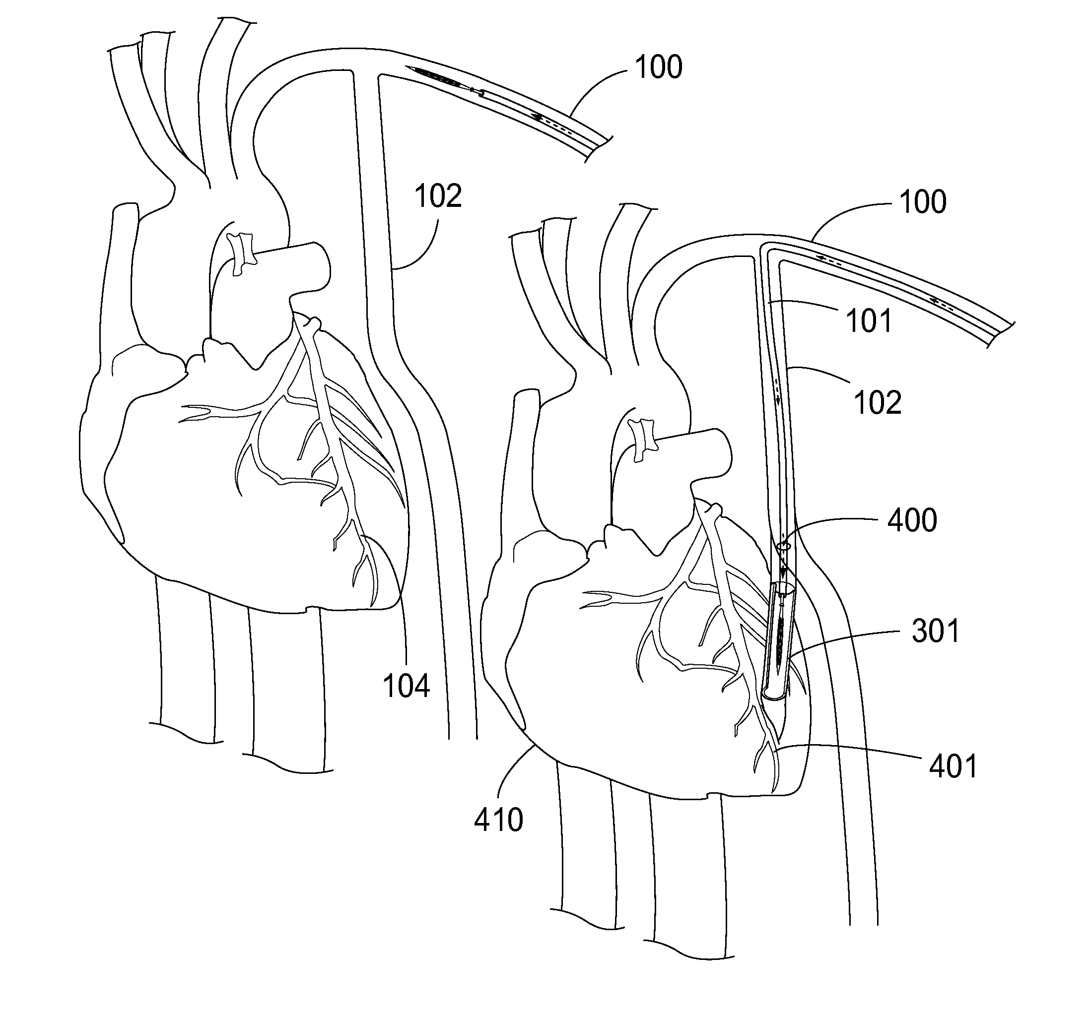 Device, system, kit, and method for epicardial access