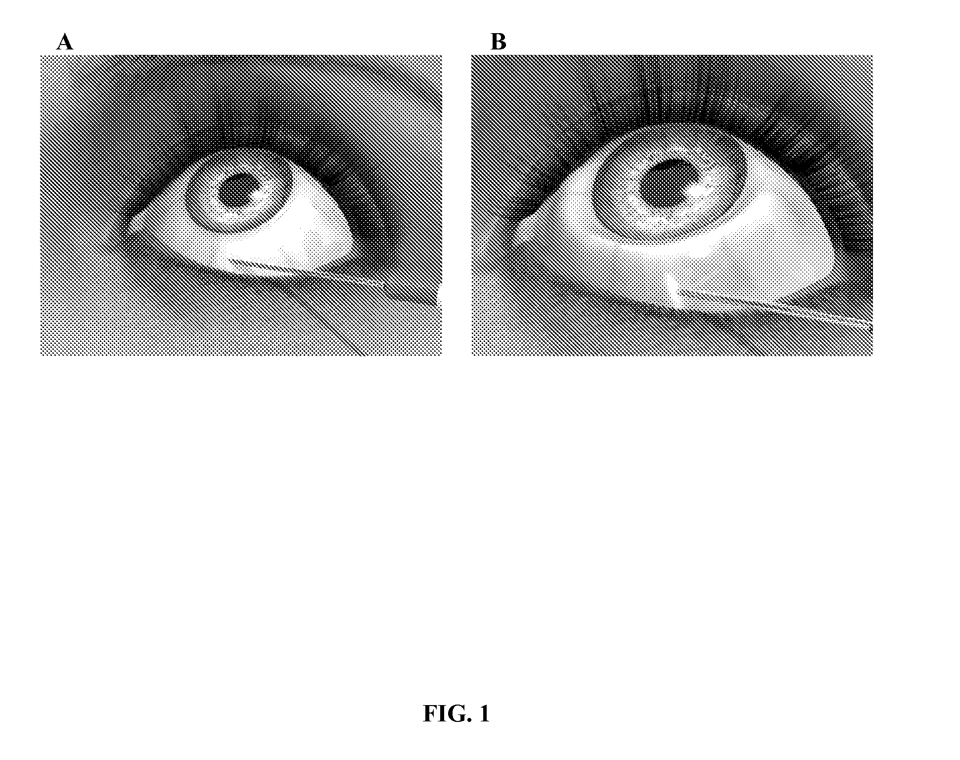 Method for treating primary and secondary forms of glaucoma