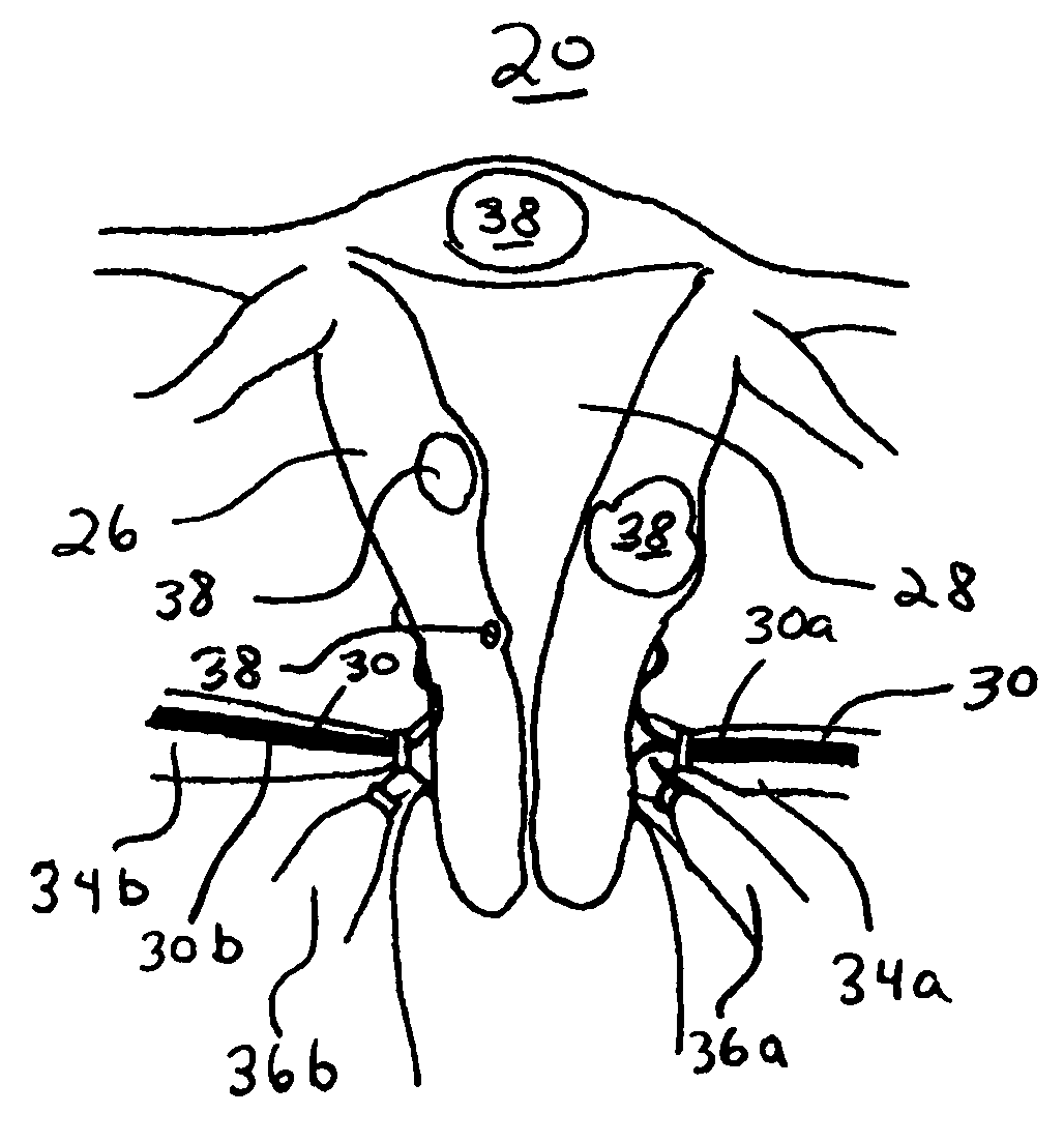 Transvaginal uterine artery occlusion for treatment of uterine leiomyomas