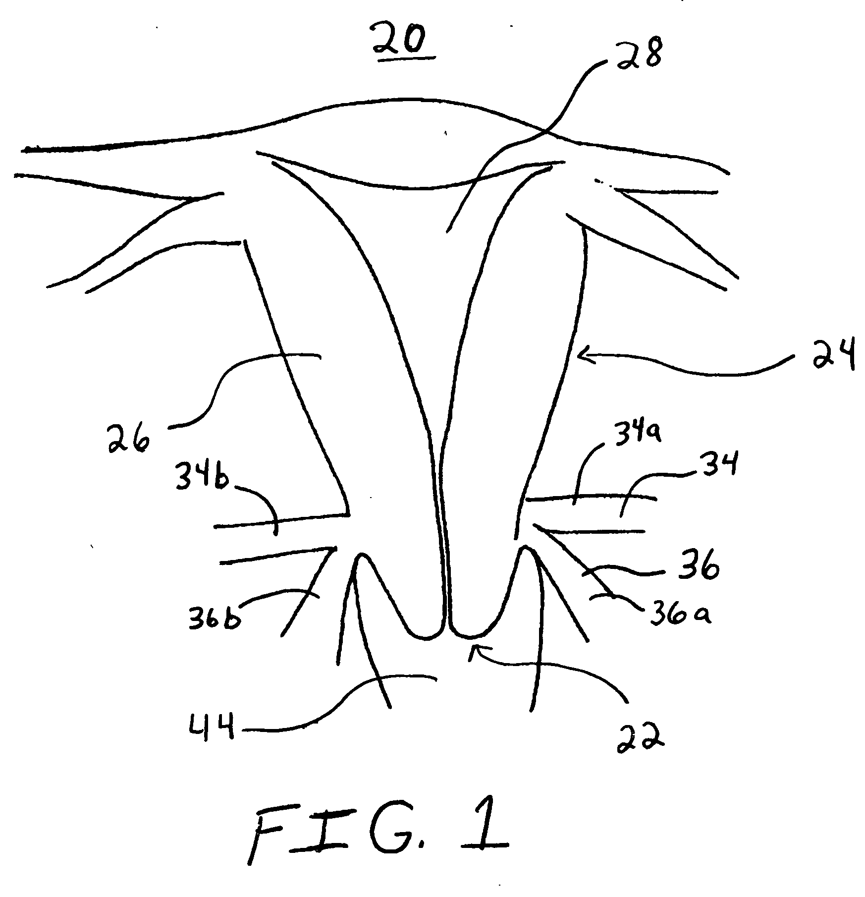 Transvaginal uterine artery occlusion for treatment of uterine leiomyomas