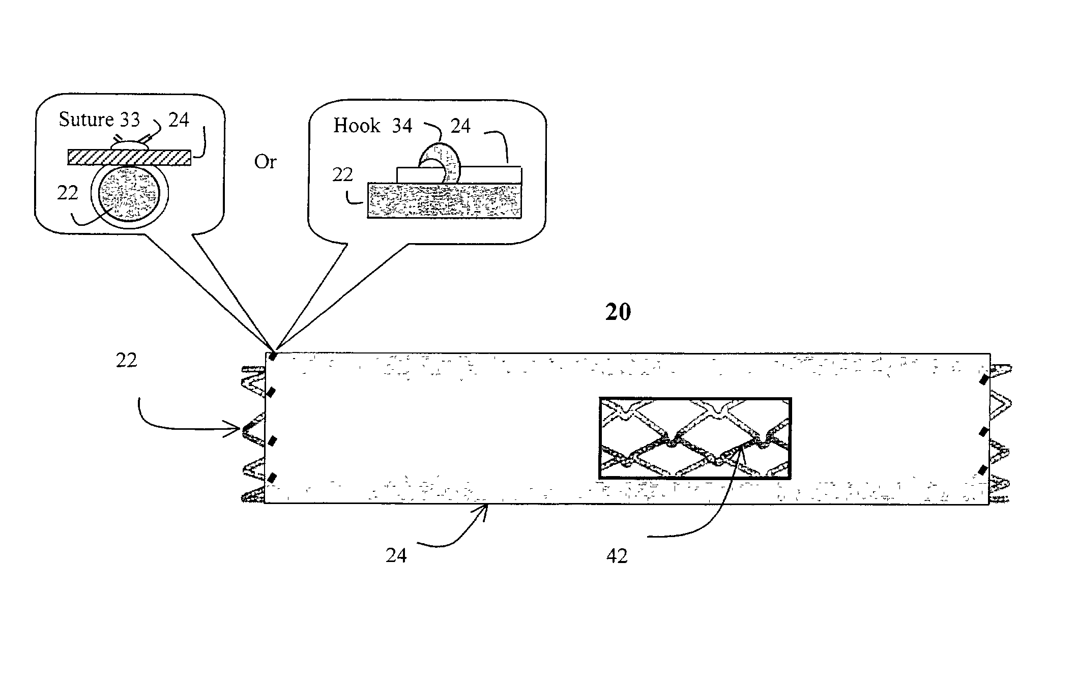 Stent having cover with drug delivery capability