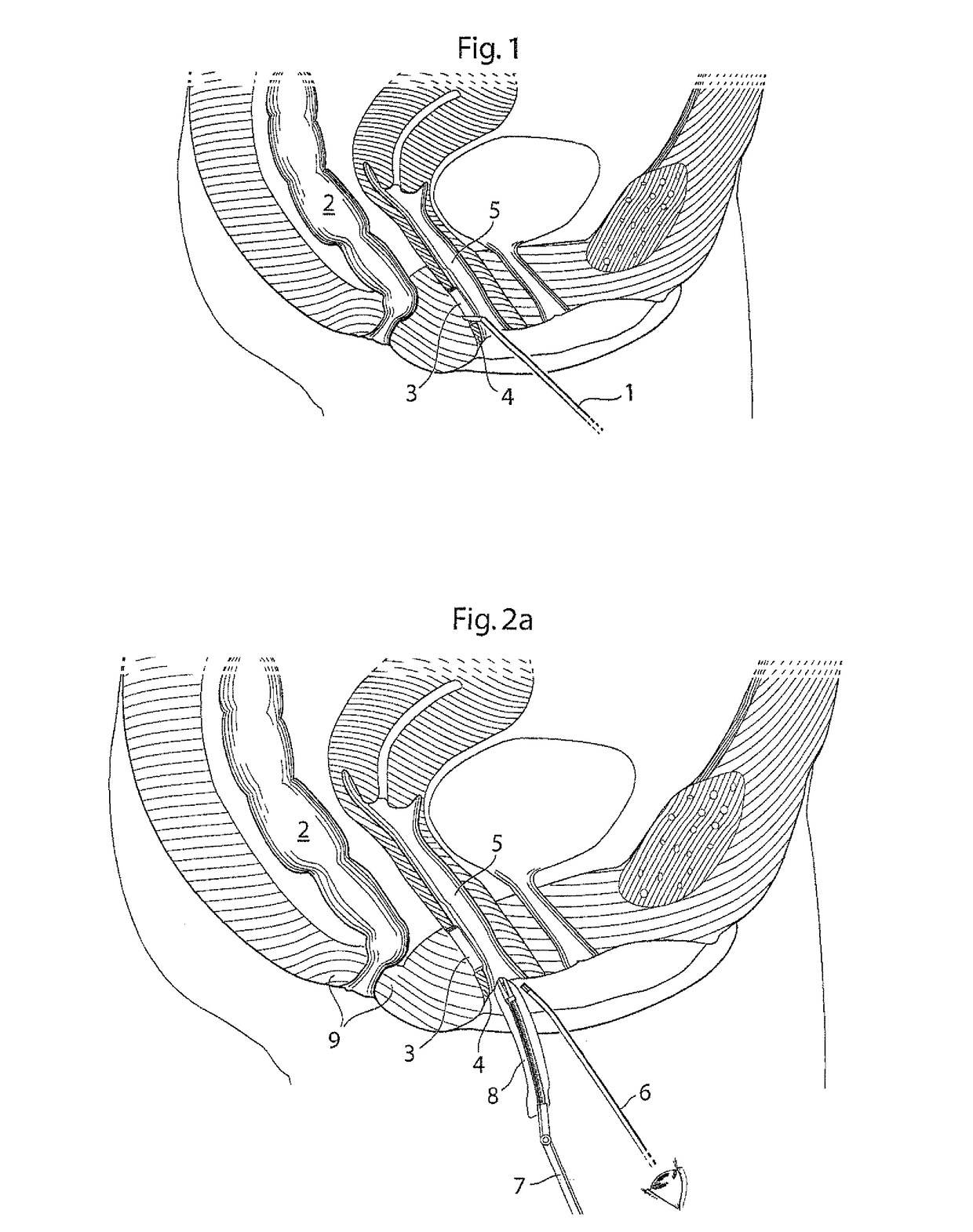 Vaginal operation method for the treatment of anal incontinence in women