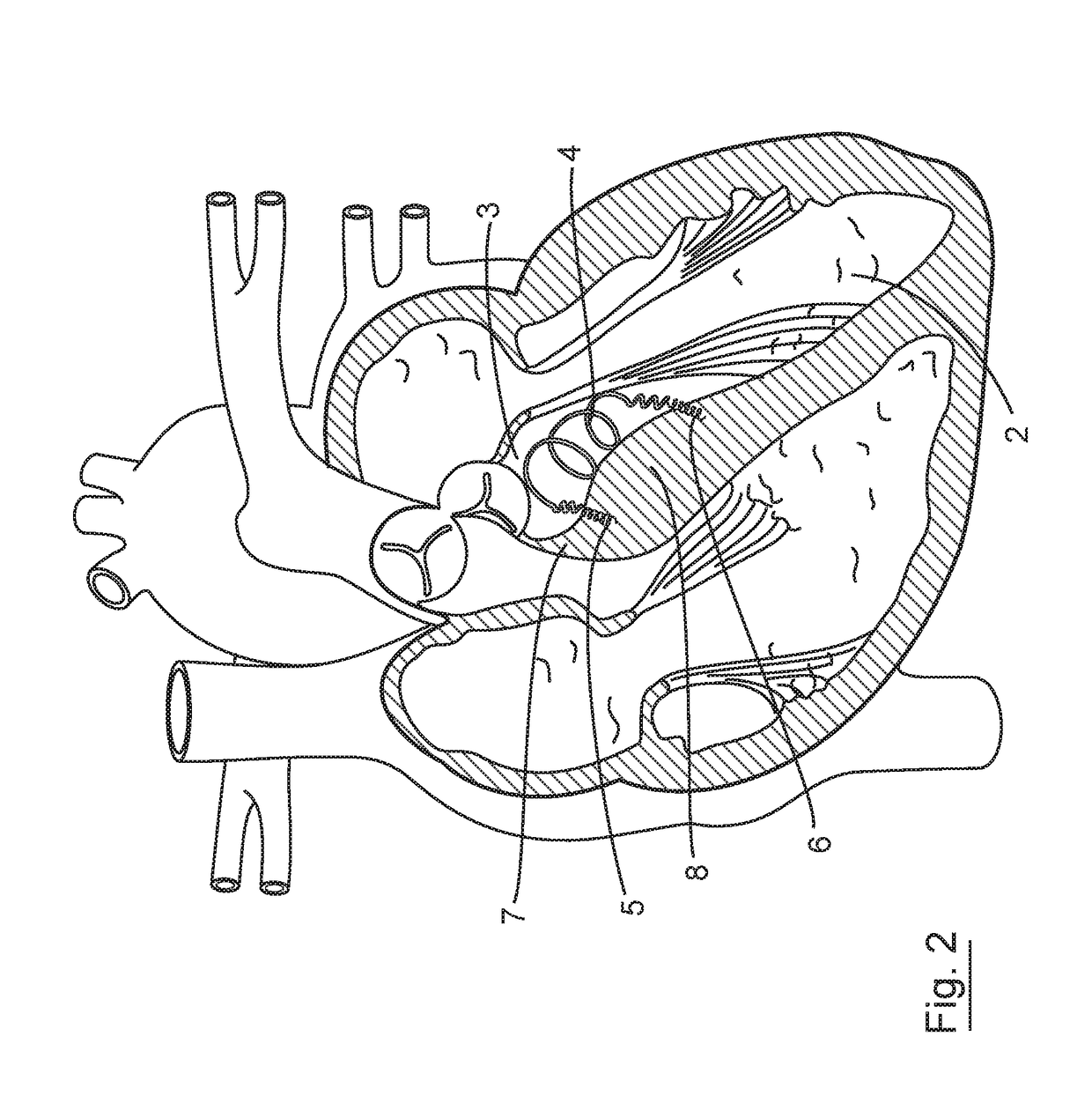 Implantable intracardiac device and methods thereof