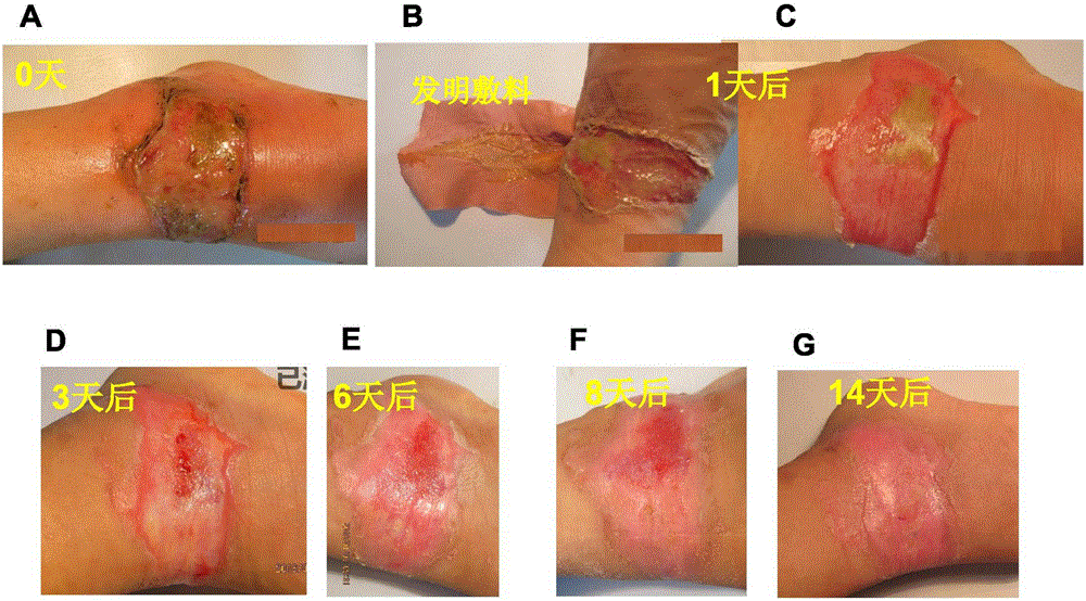 Multifunctional Compound Skin Or Wound Dressing As Regenerative Skin Substitute