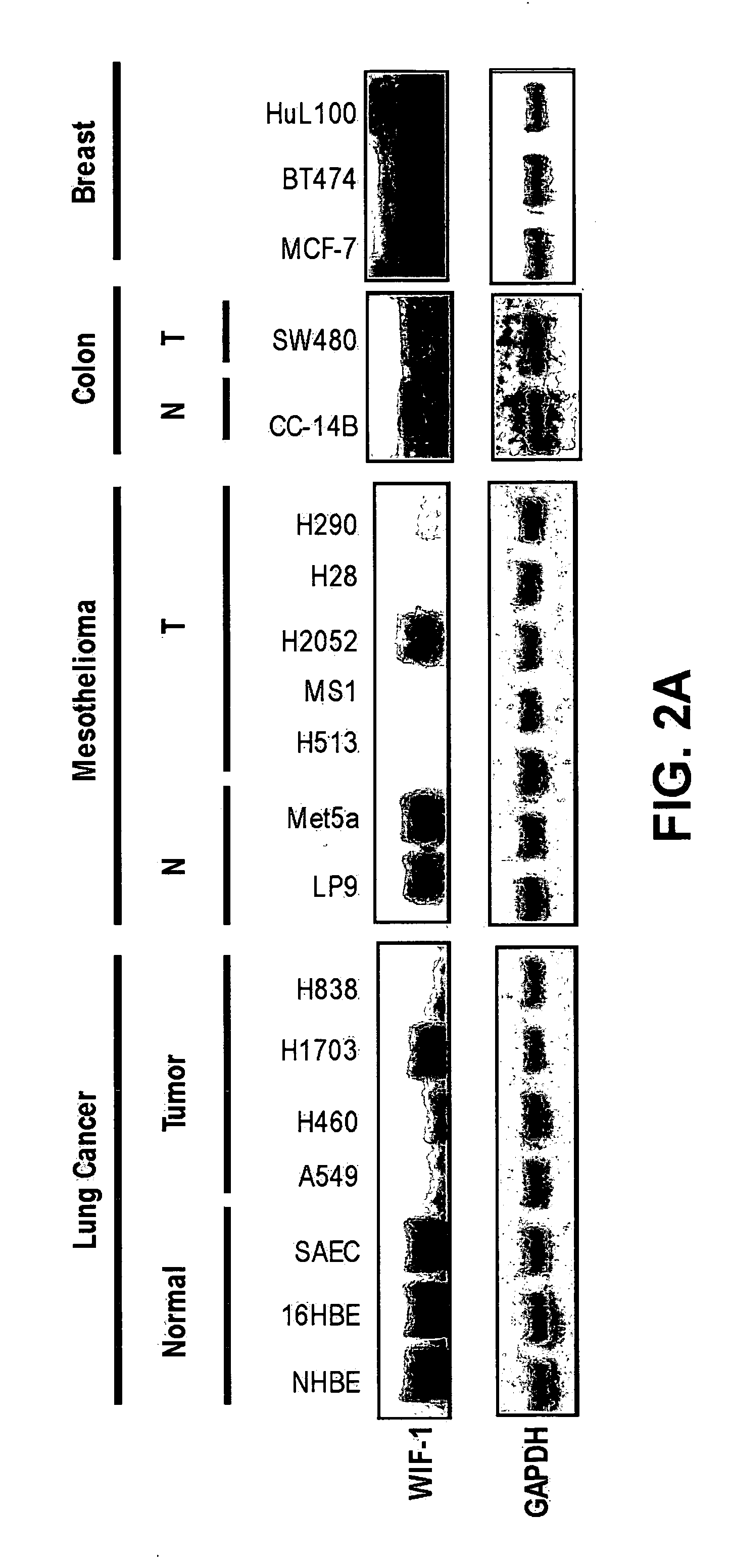 Methods for treating and diagnosing cancer with WNT inhibitory Factor-1 (WIF-1)