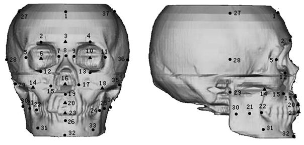 Zonal statistic model based facial reconstruction method