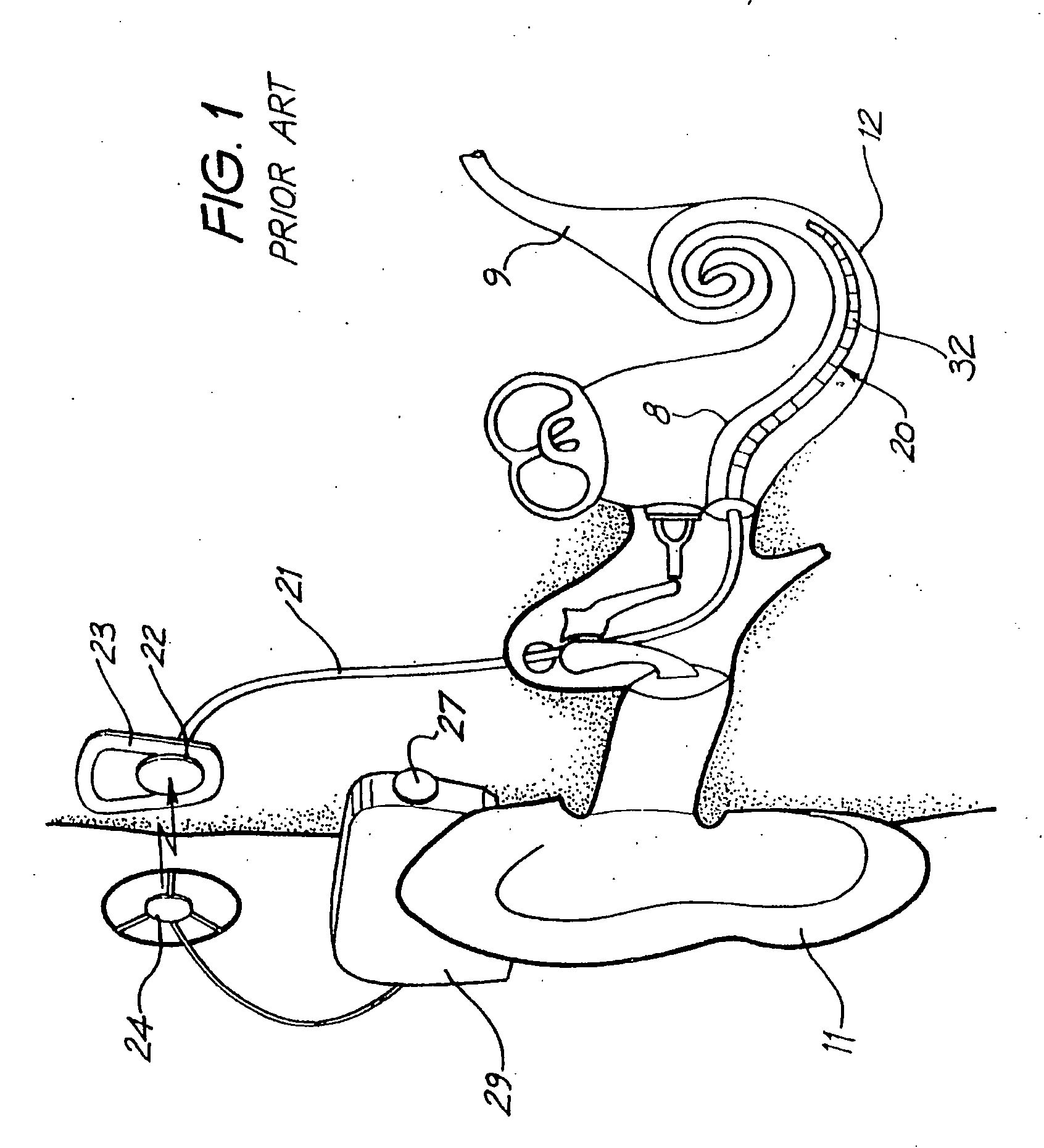 Cochlear implant drug delivery device