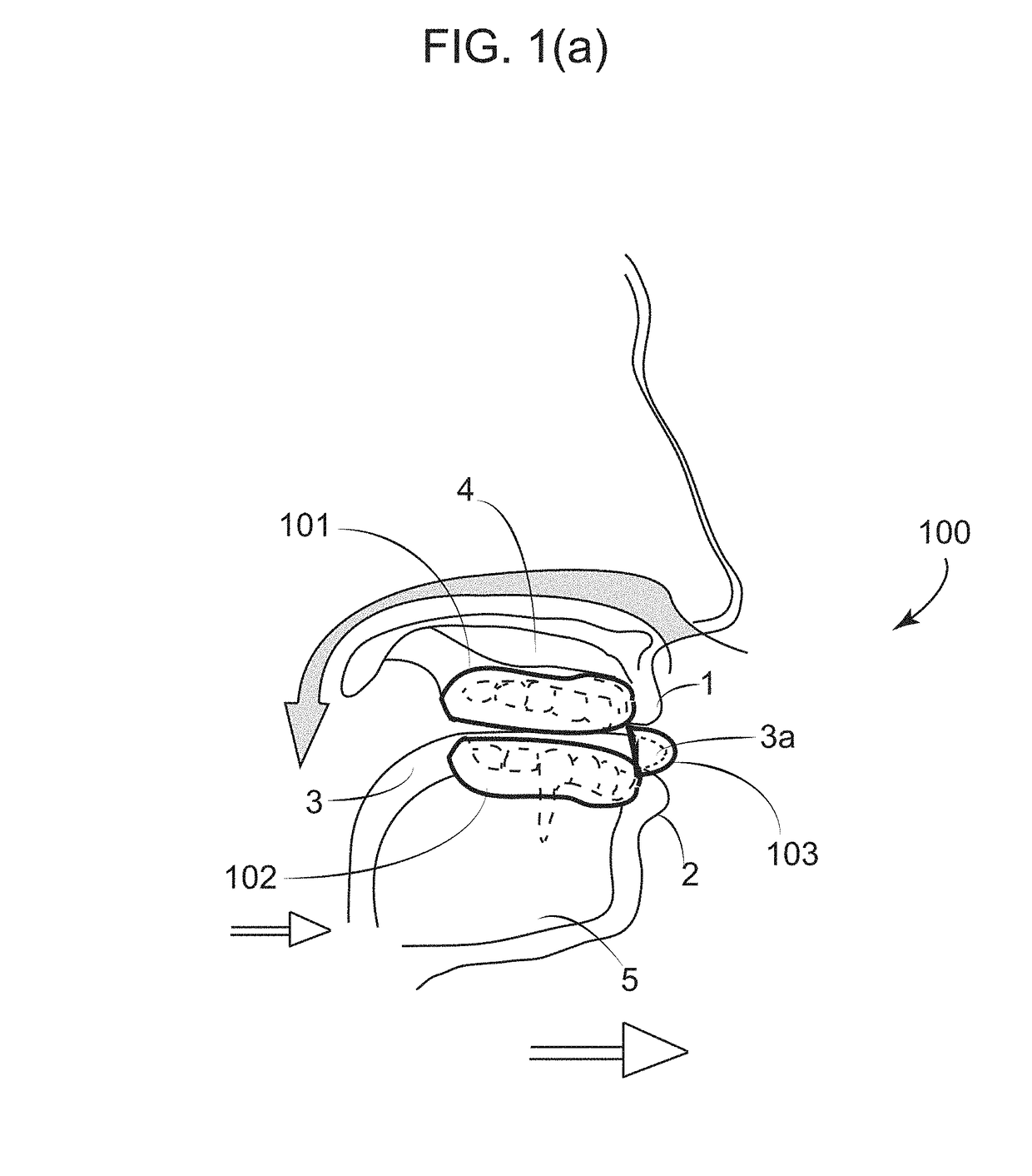 Dental Appliance