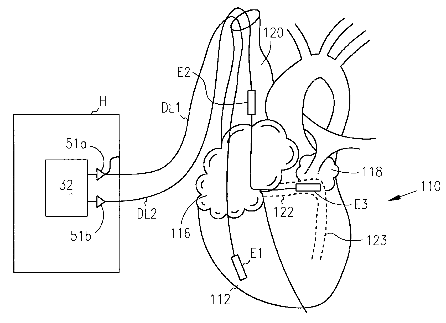 Method and apparatus for termination of cardiac tachyarrhythmias