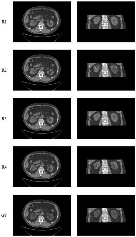 Urinography CT image kidney segmentation method and system