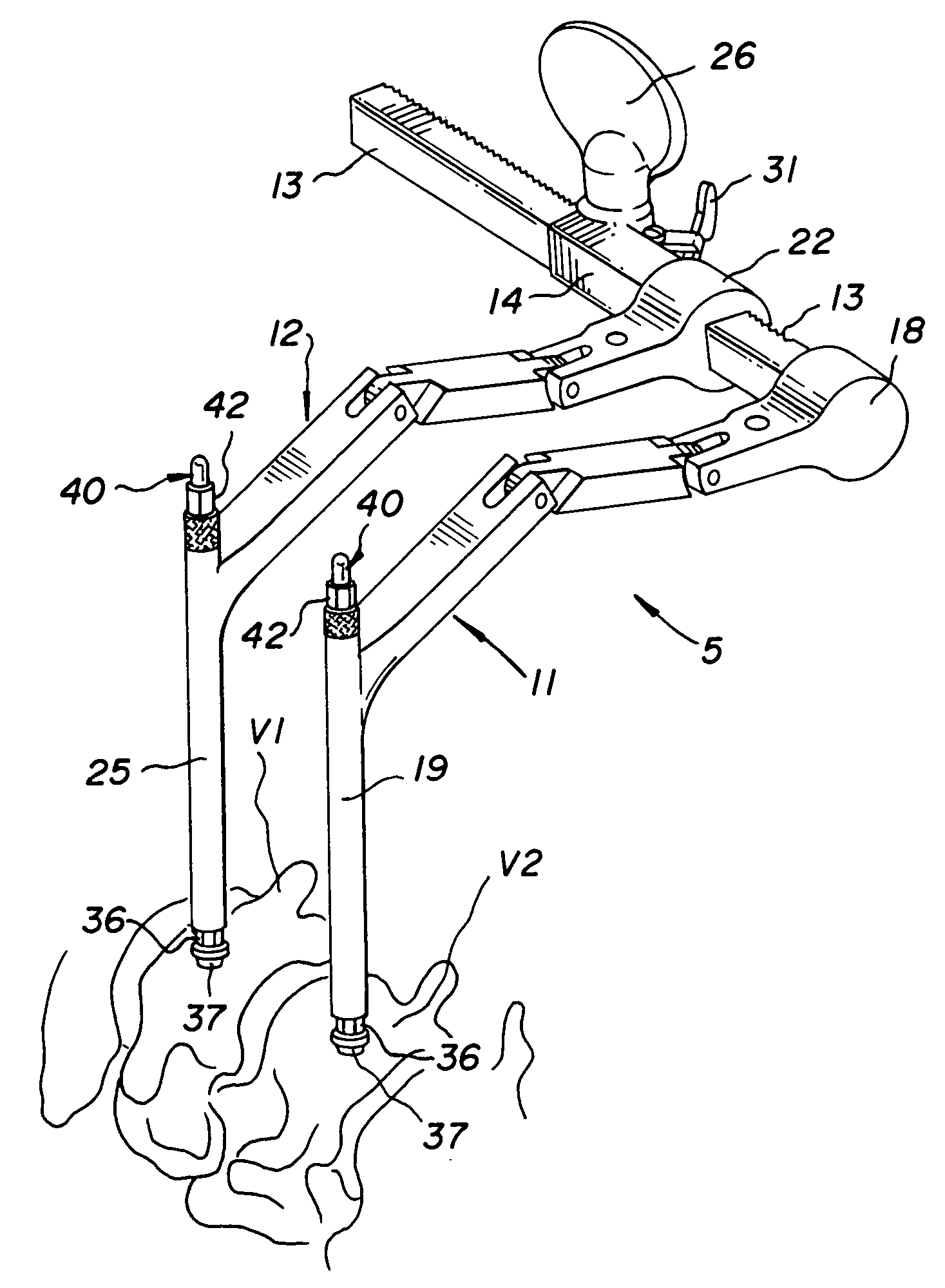 Vertebral retainer-distracter and method of using same