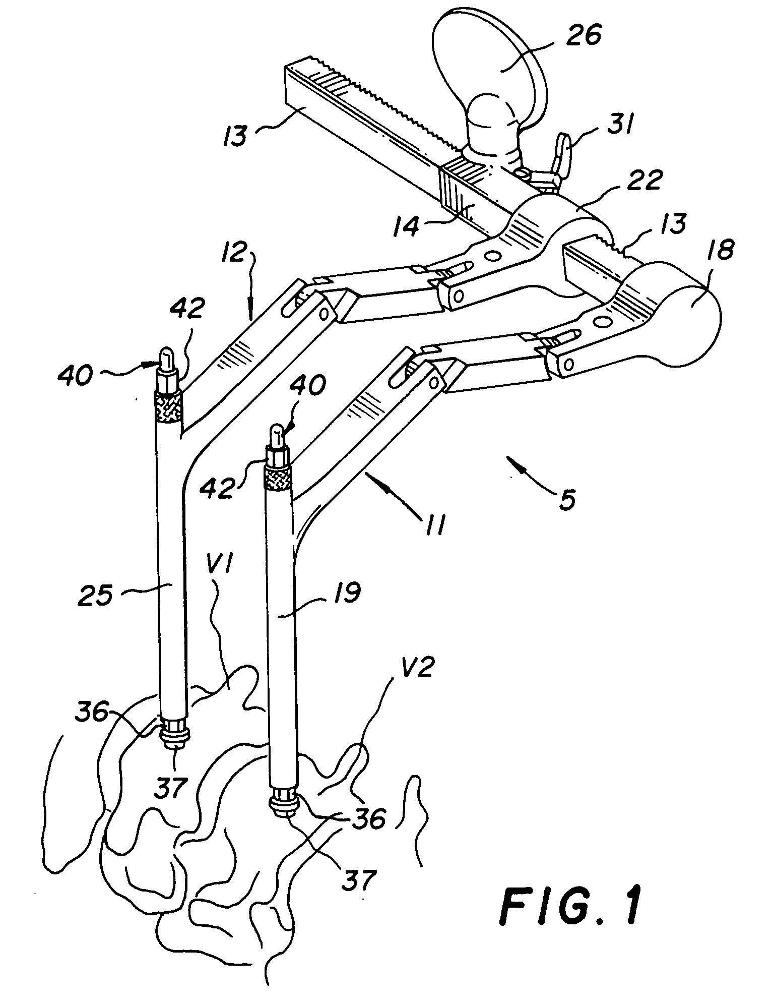 Vertebral retainer-distracter and method of using same